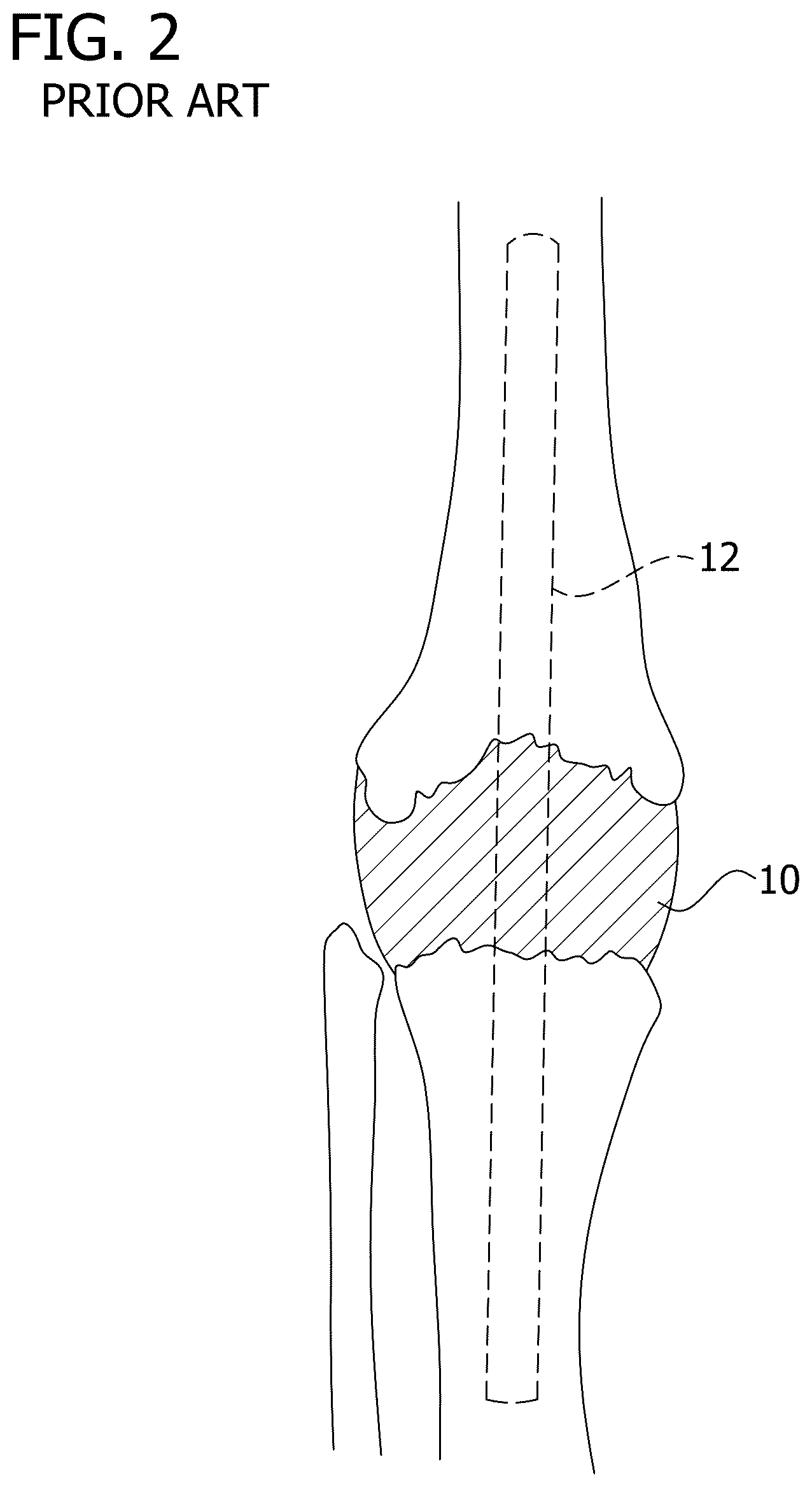 Patent US12616577 Figure 2 – Hinged articulating spacer system for revision knee arthroplasty