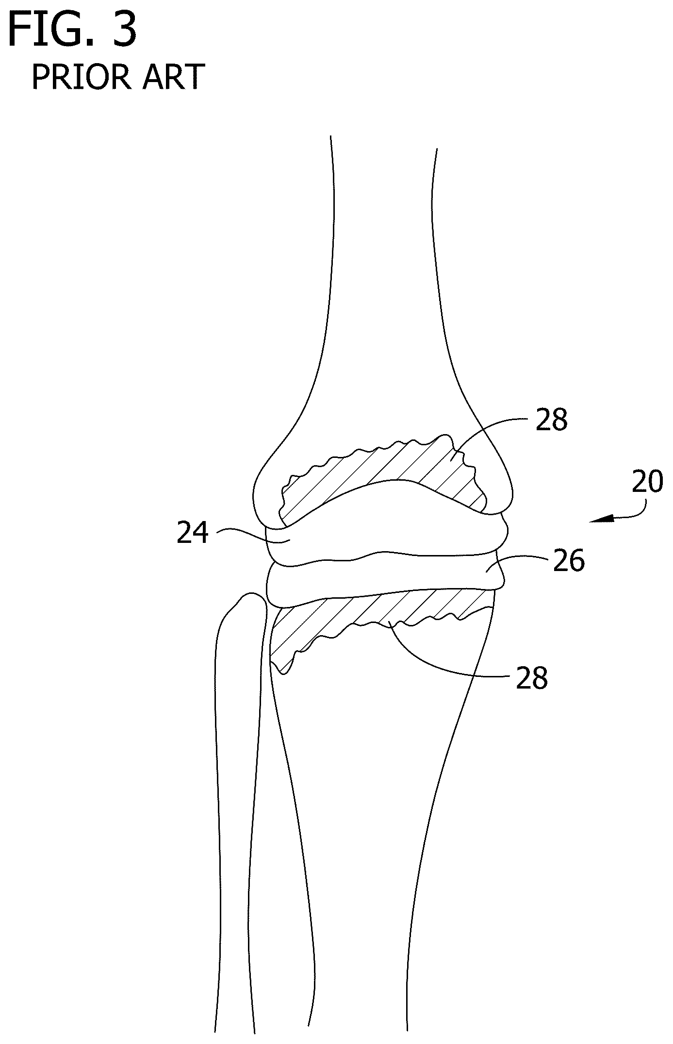 Patent US12616577 Figure 3 – Hinged articulating spacer system for revision knee arthroplasty