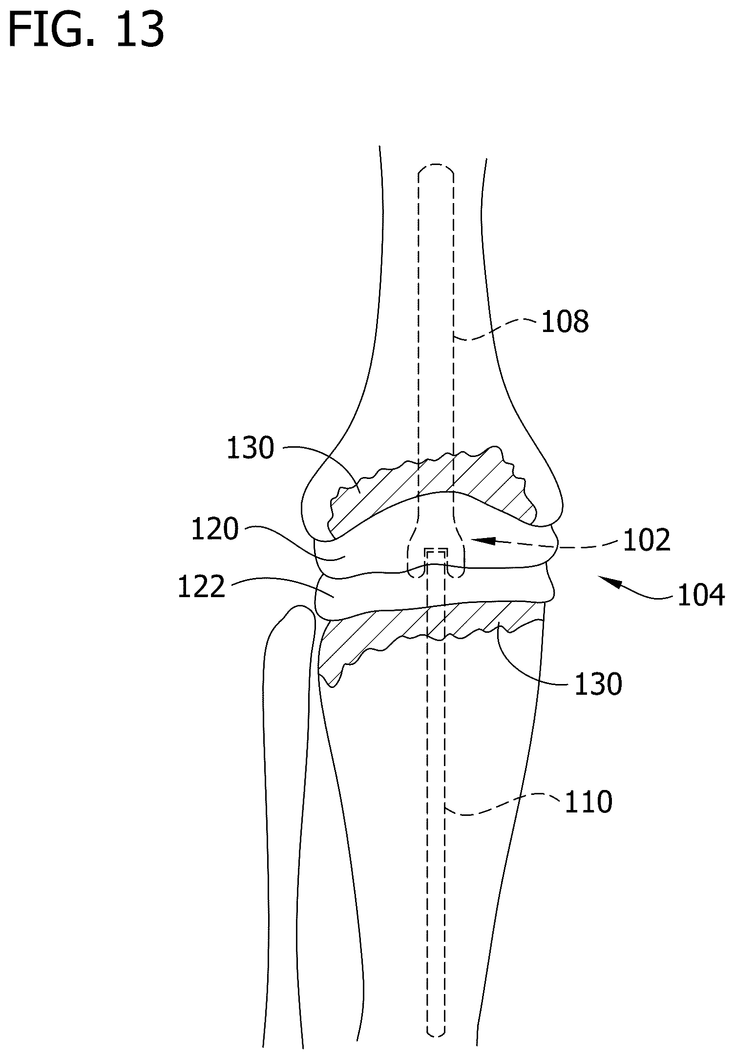 Patent US12616577 Figure 10 – Hinged articulating spacer system for revision knee arthroplasty