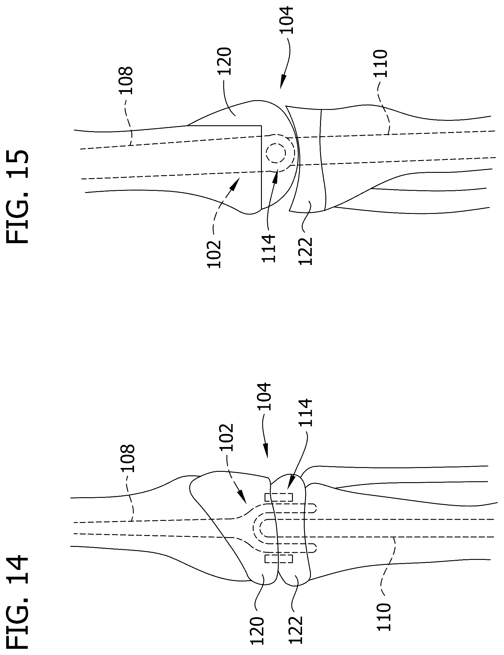Patent US12616577 Figure 11 – Hinged articulating spacer system for revision knee arthroplasty
