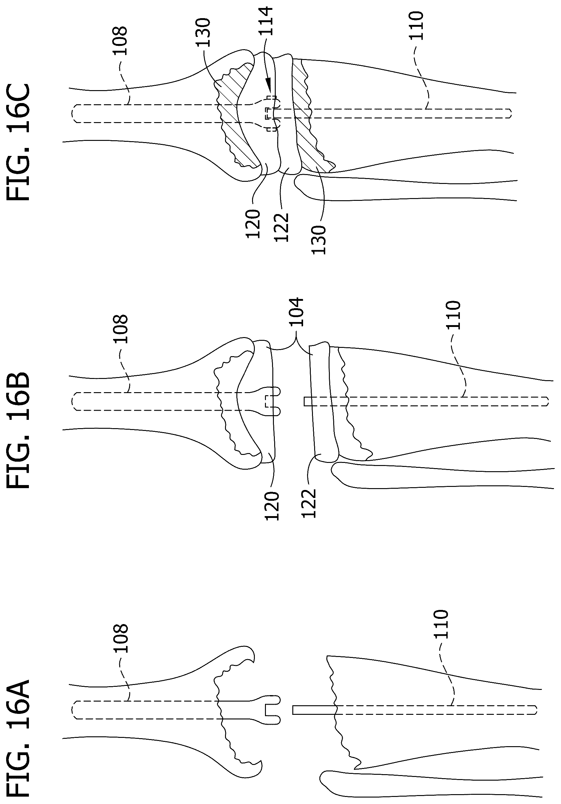 Patent US12616577 Figure 12 – Hinged articulating spacer system for revision knee arthroplasty