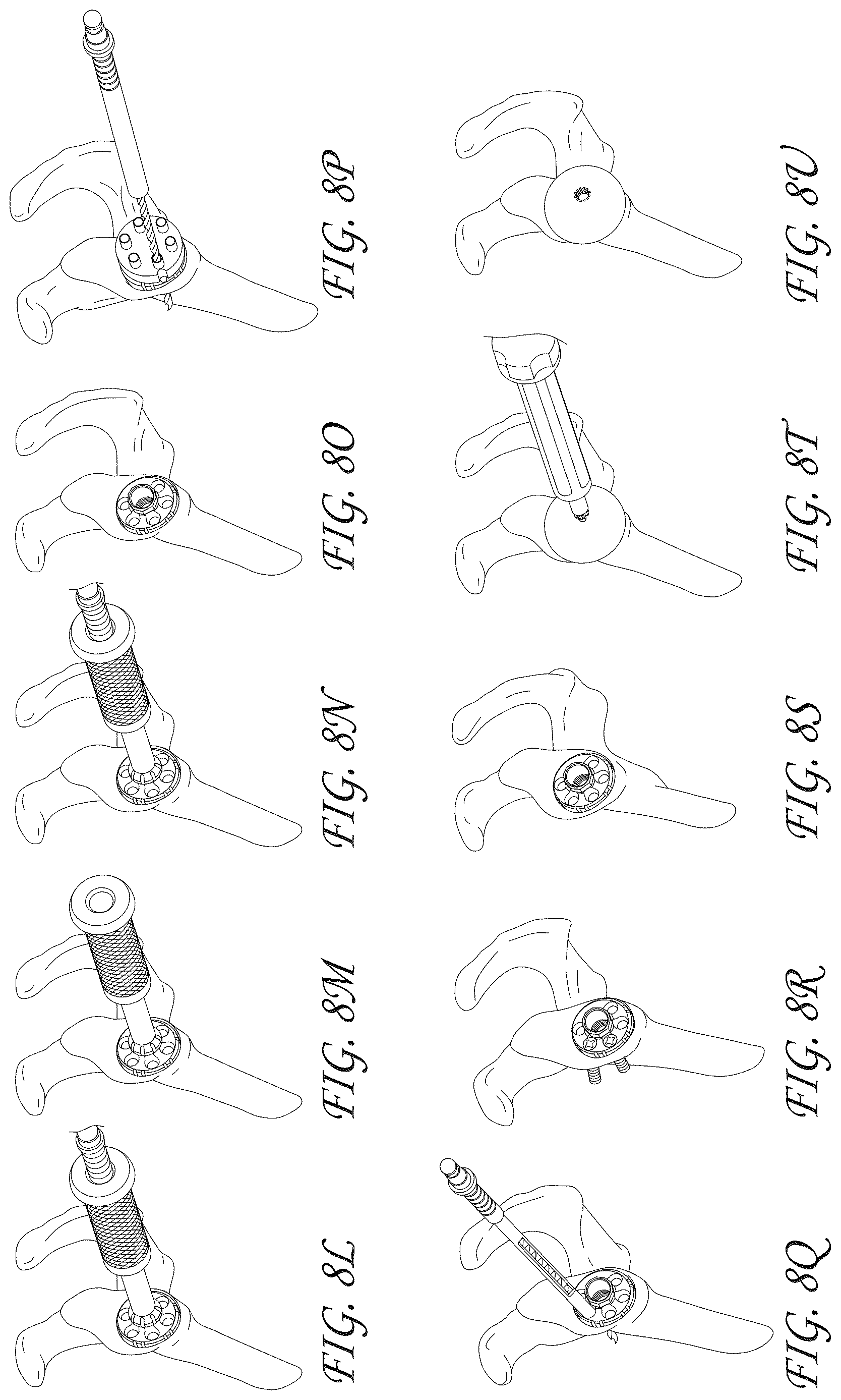 Patent US12616578 Figure 10 – Total reverse shoulder systems and methods