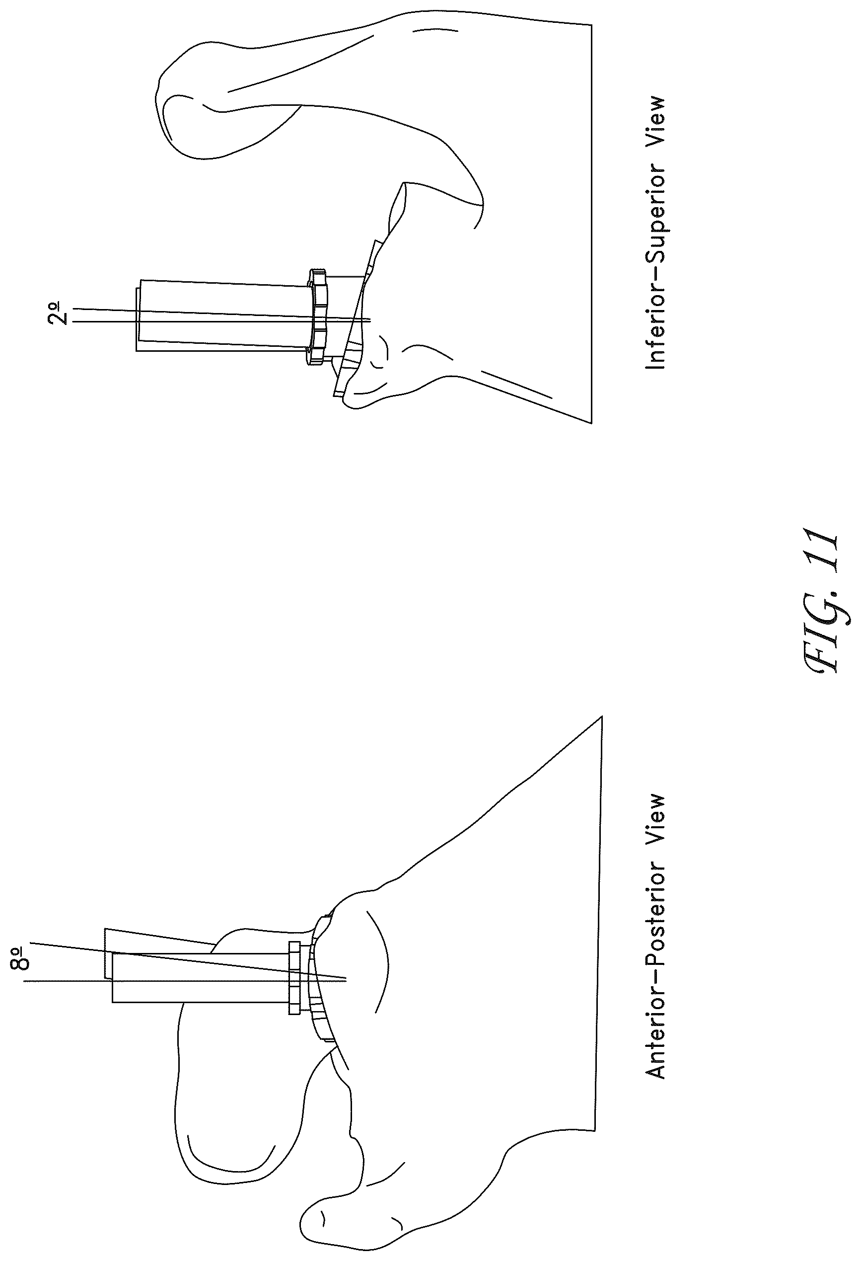 Patent US12616578 Figure 13 – Total reverse shoulder systems and methods