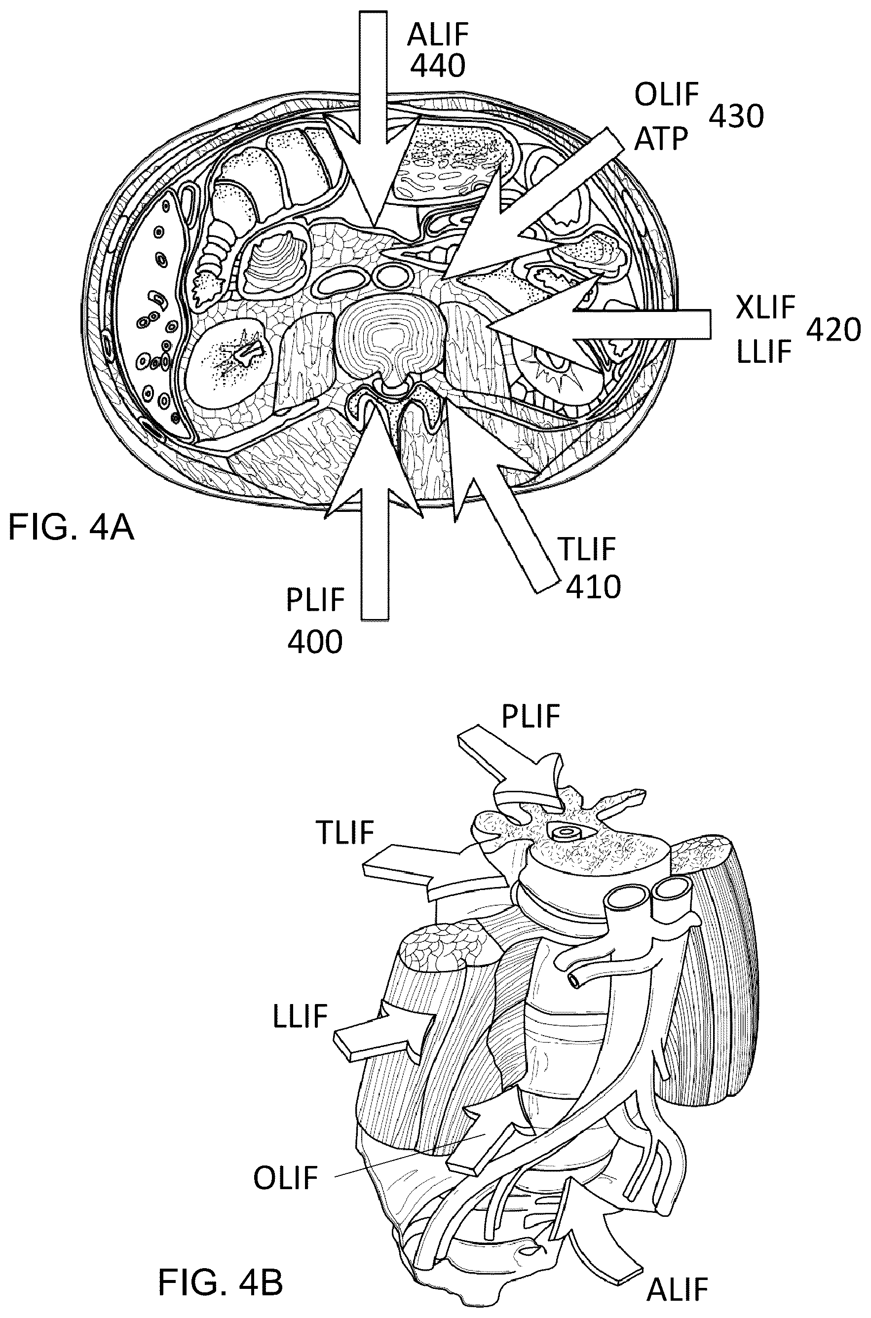 Patent US12616581 Figure 4 – Methods for restoring bilateral spinal alignment and/or range of motion