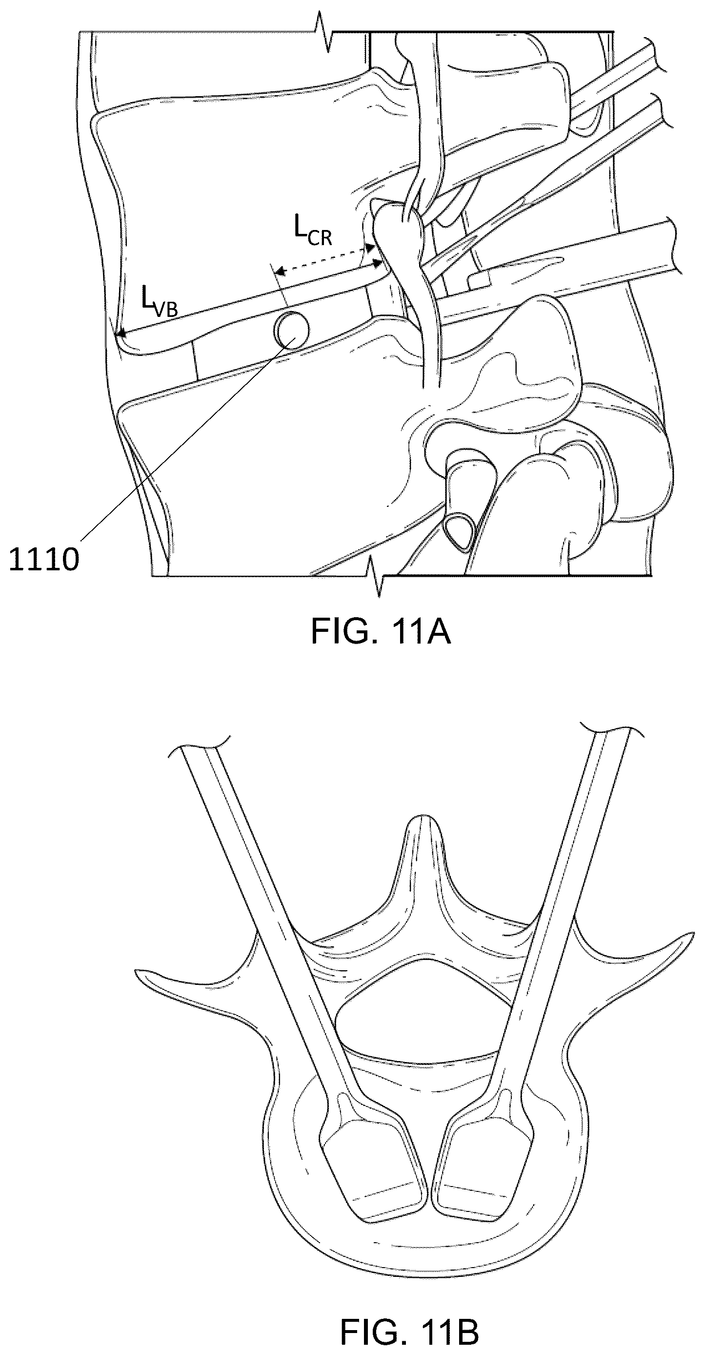 Patent US12616581 Figure 12 – Methods for restoring bilateral spinal alignment and/or range of motion