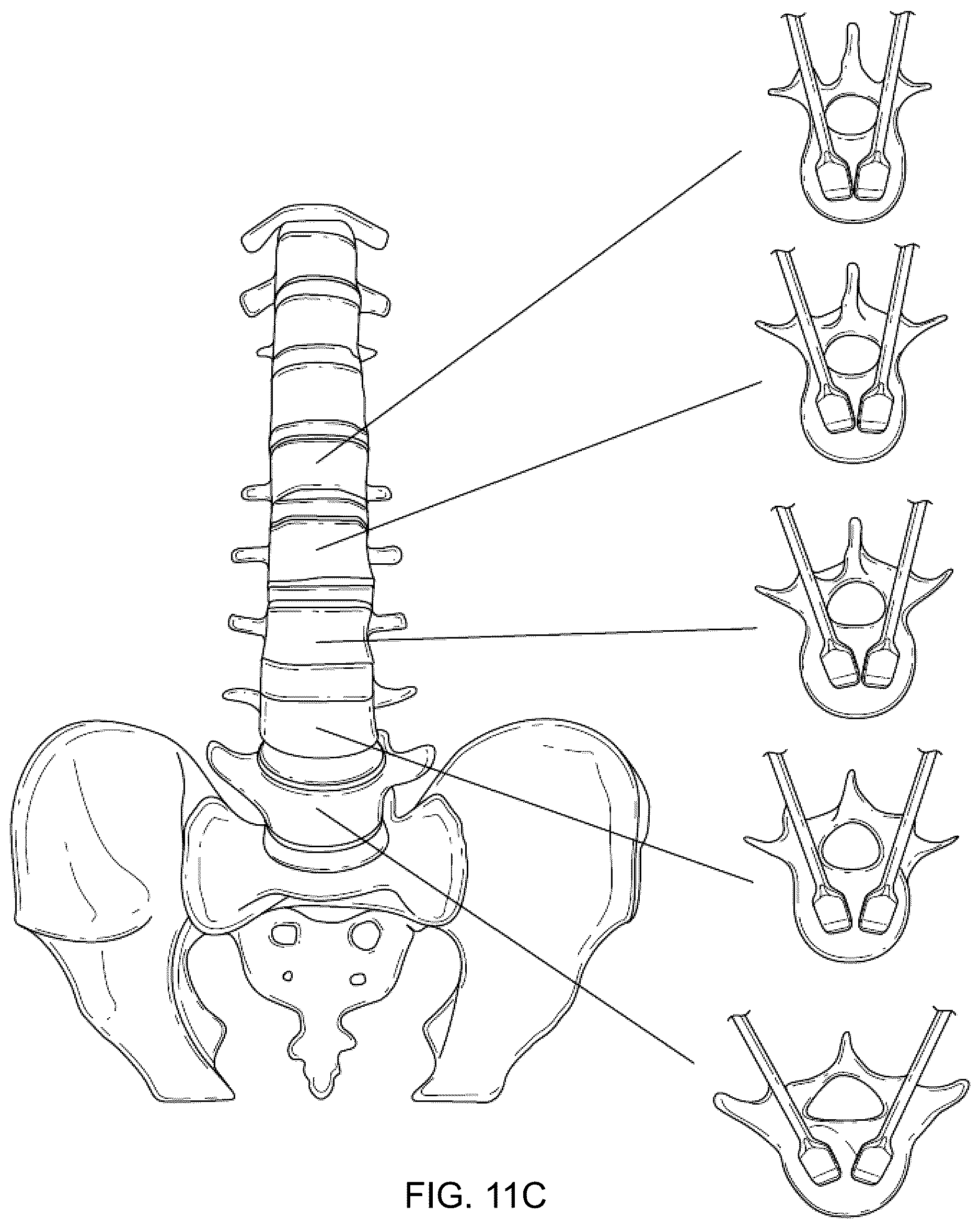 Patent US12616581 Figure 13 – Methods for restoring bilateral spinal alignment and/or range of motion
