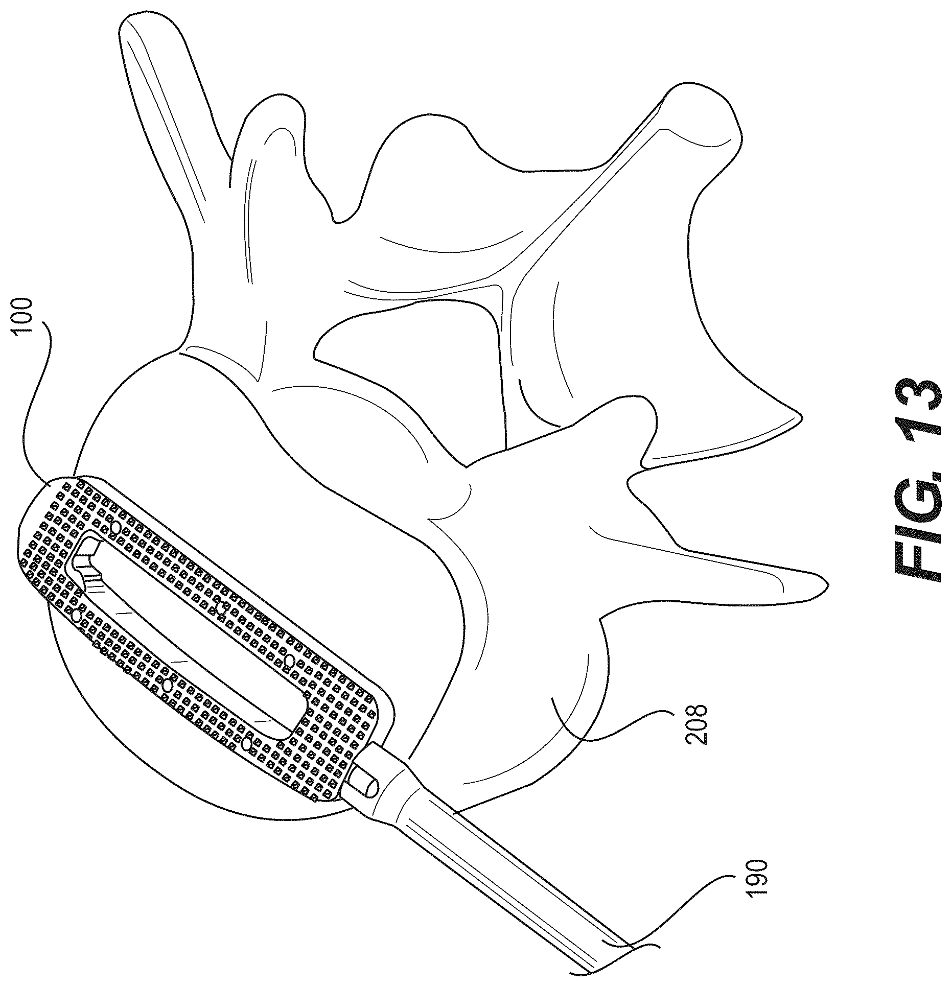 Patent US12616586 Figure 11 – Stabilized intervertebral spacer
