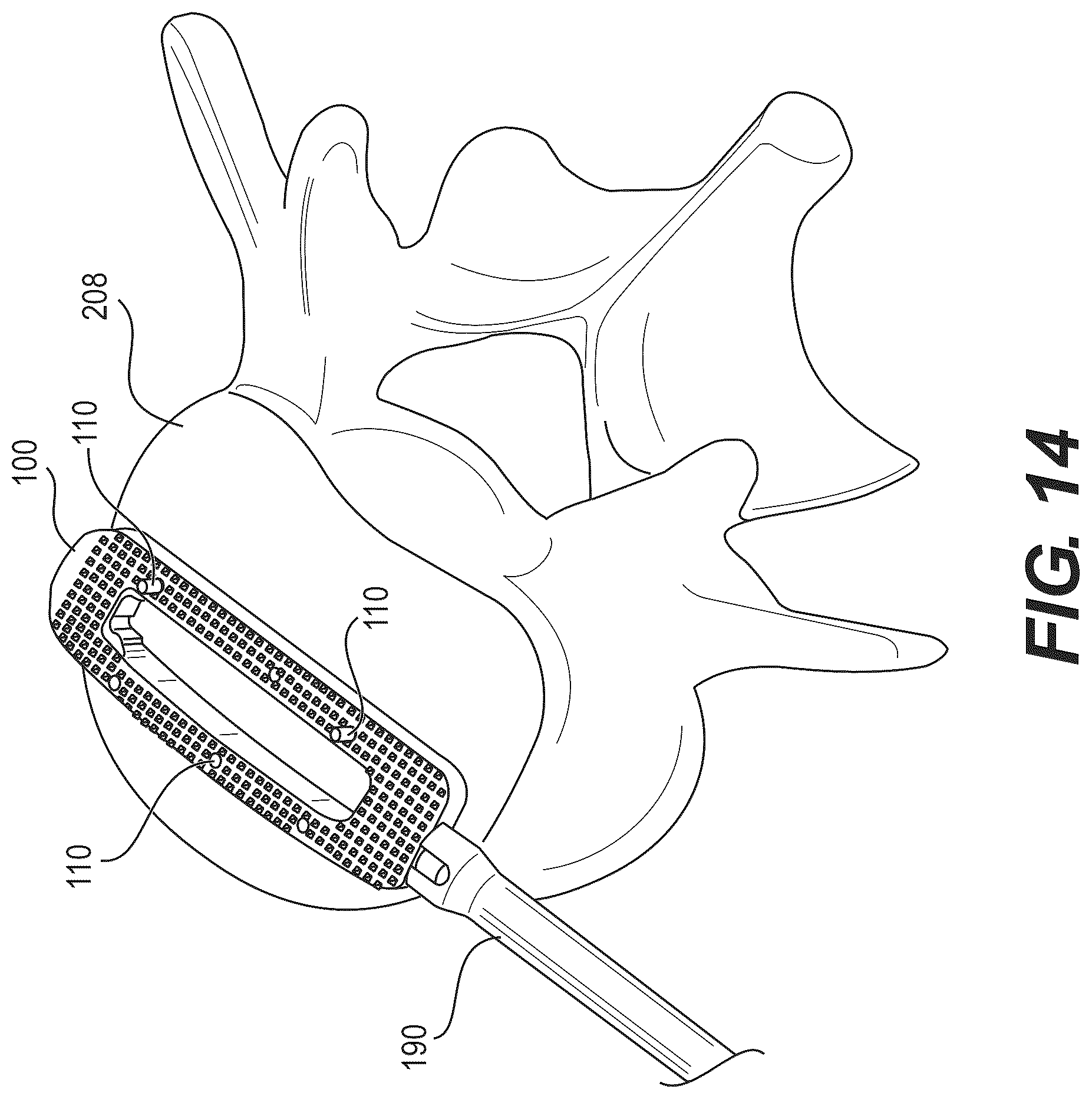 Patent US12616586 Figure 12 – Stabilized intervertebral spacer