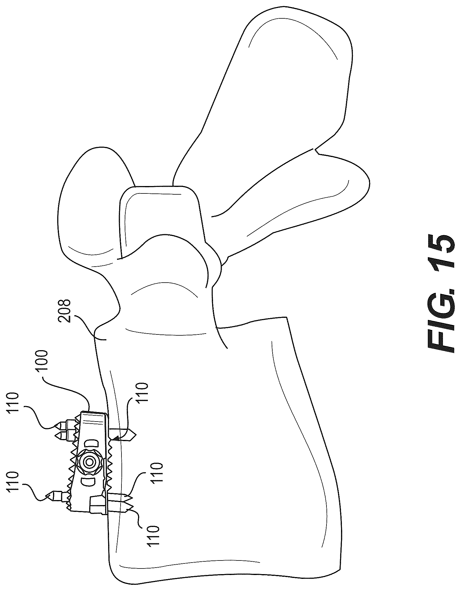Patent US12616586 Figure 13 – Stabilized intervertebral spacer