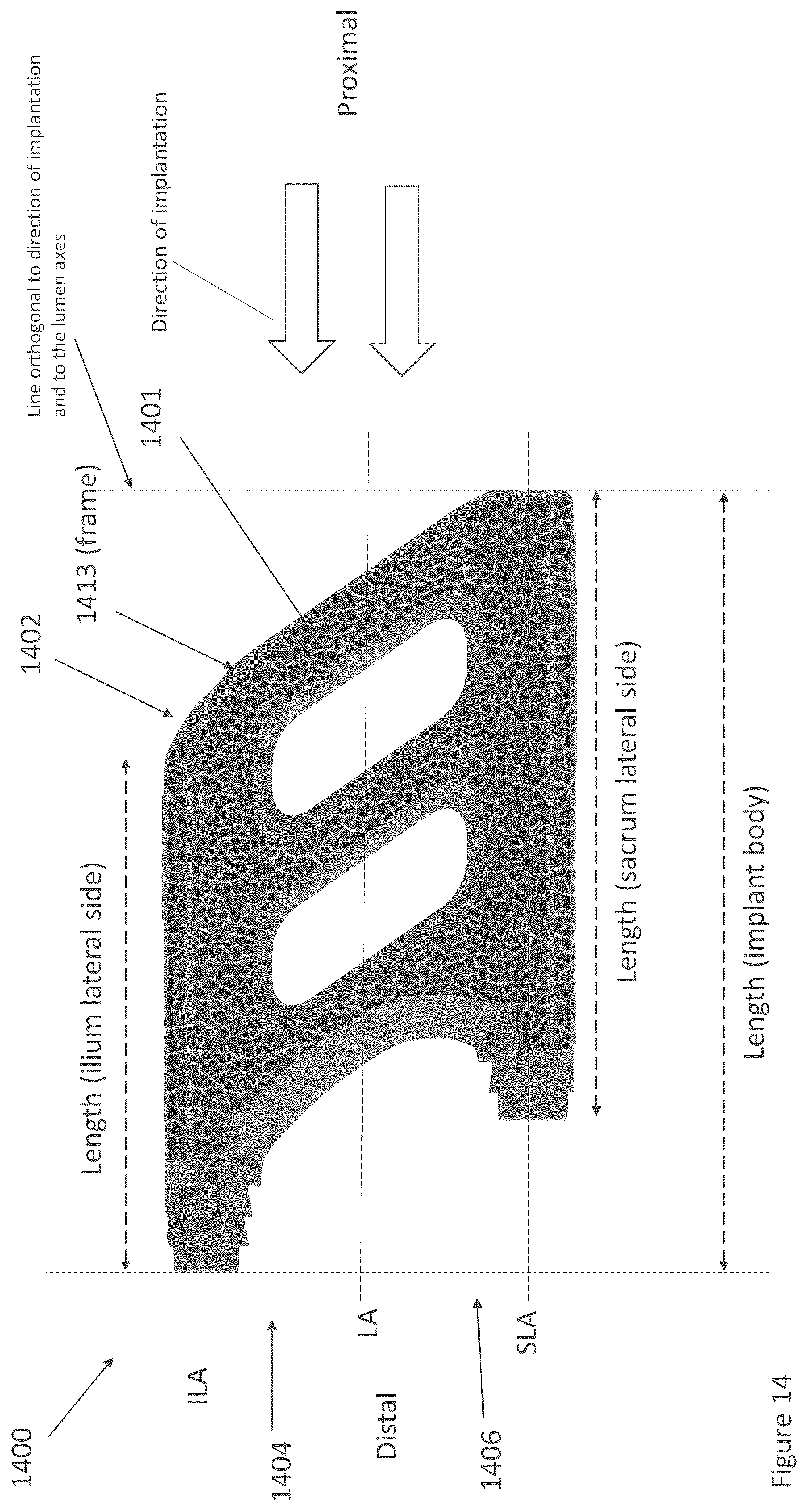 Patent US12616587 Figure 12 – Sacro-iliac joint stabilizing implants and methods of implantation
