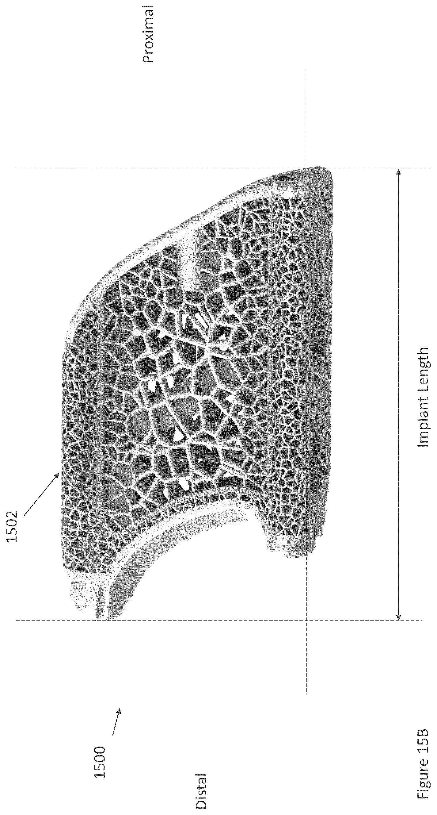 Patent US12616587 Figure 14 – Sacro-iliac joint stabilizing implants and methods of implantation