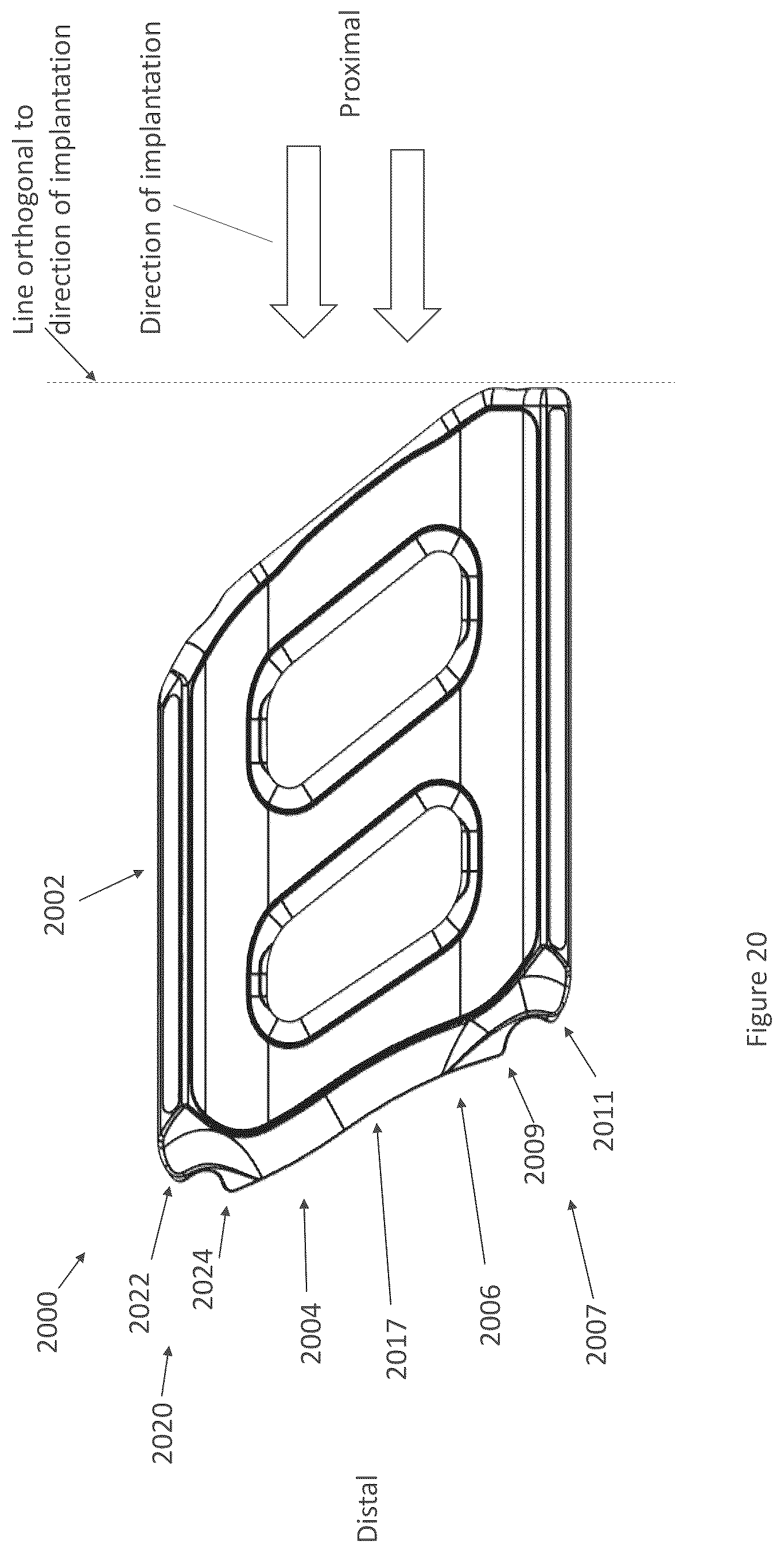 Patent US12616587 Figure 20 – Sacro-iliac joint stabilizing implants and methods of implantation