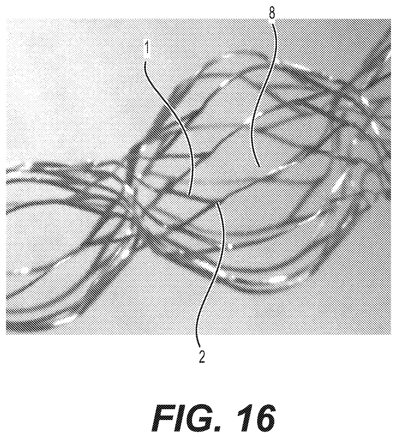 Patent US12616592 Figure 17 – Bidirectional stent and method of use thereof