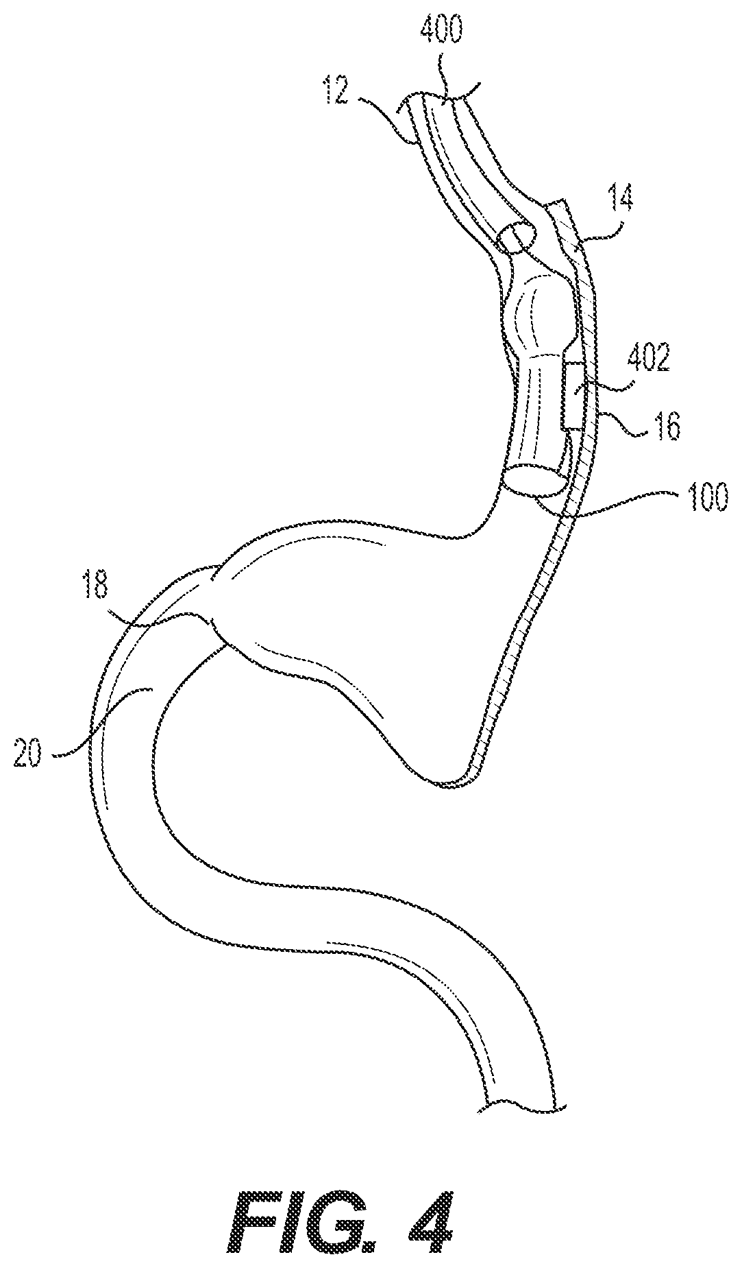 Patent US12616594 Figure 2 – Gastrointestinal bypass devices and related methods of use