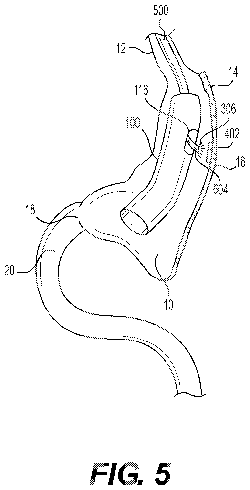 Patent US12616594 Figure 3 – Gastrointestinal bypass devices and related methods of use