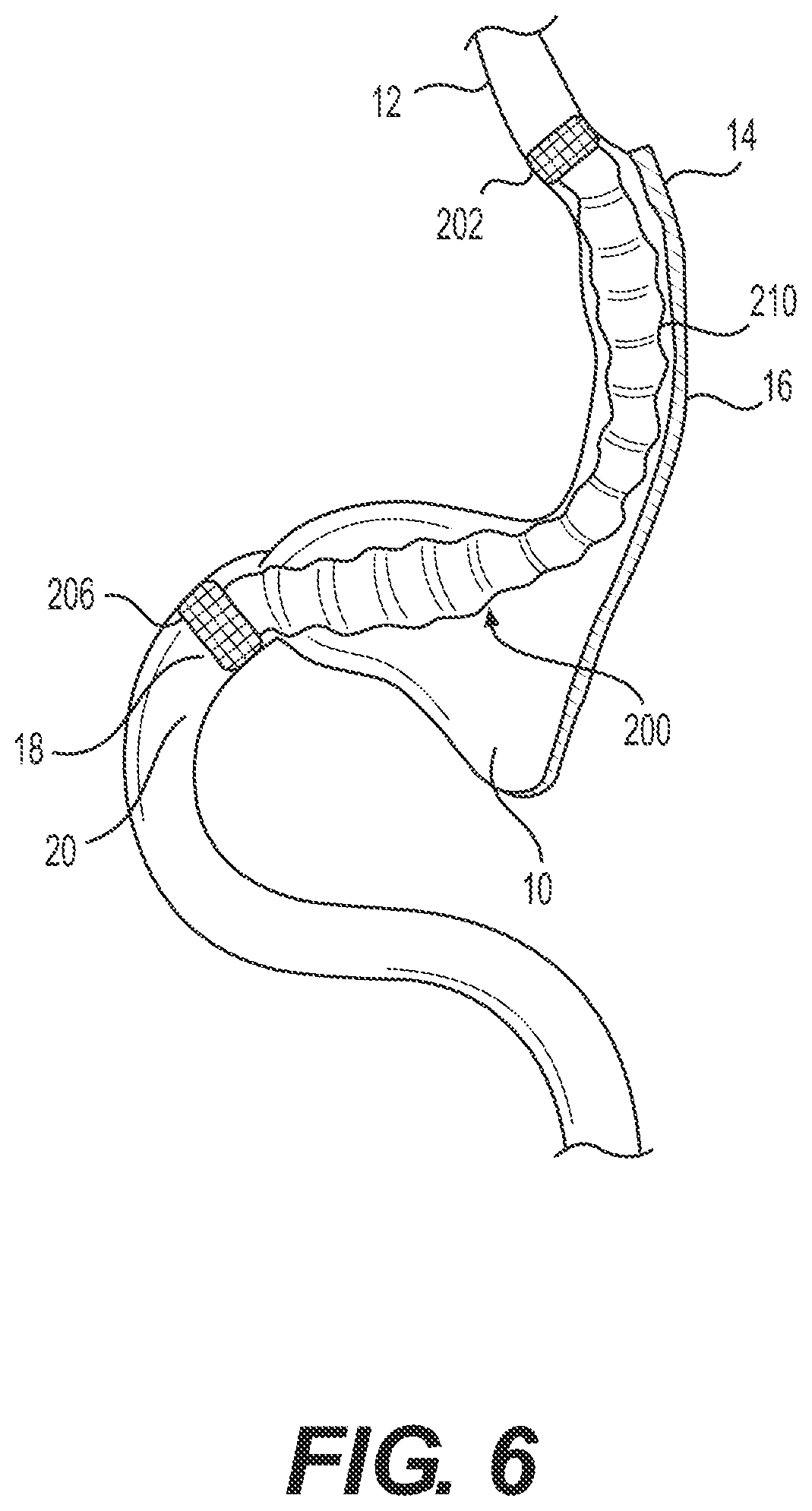 Patent US12616594 Figure 4 – Gastrointestinal bypass devices and related methods of use
