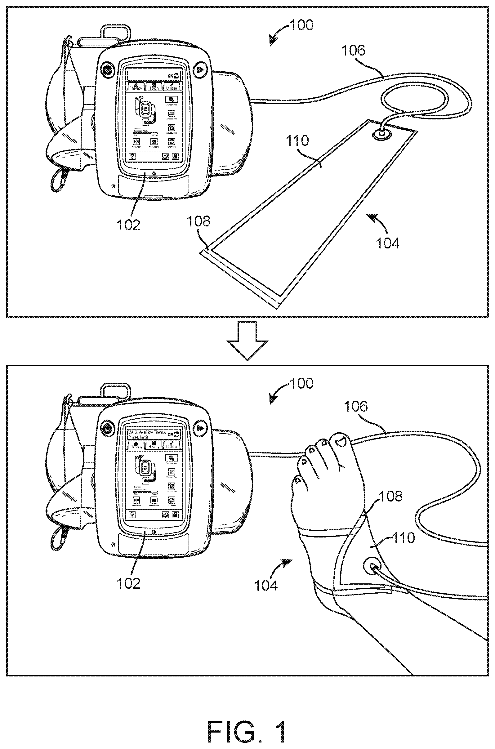 Patent US12616596 Figure 1 – Negative pressure therapy system with immobilizing locking sheets