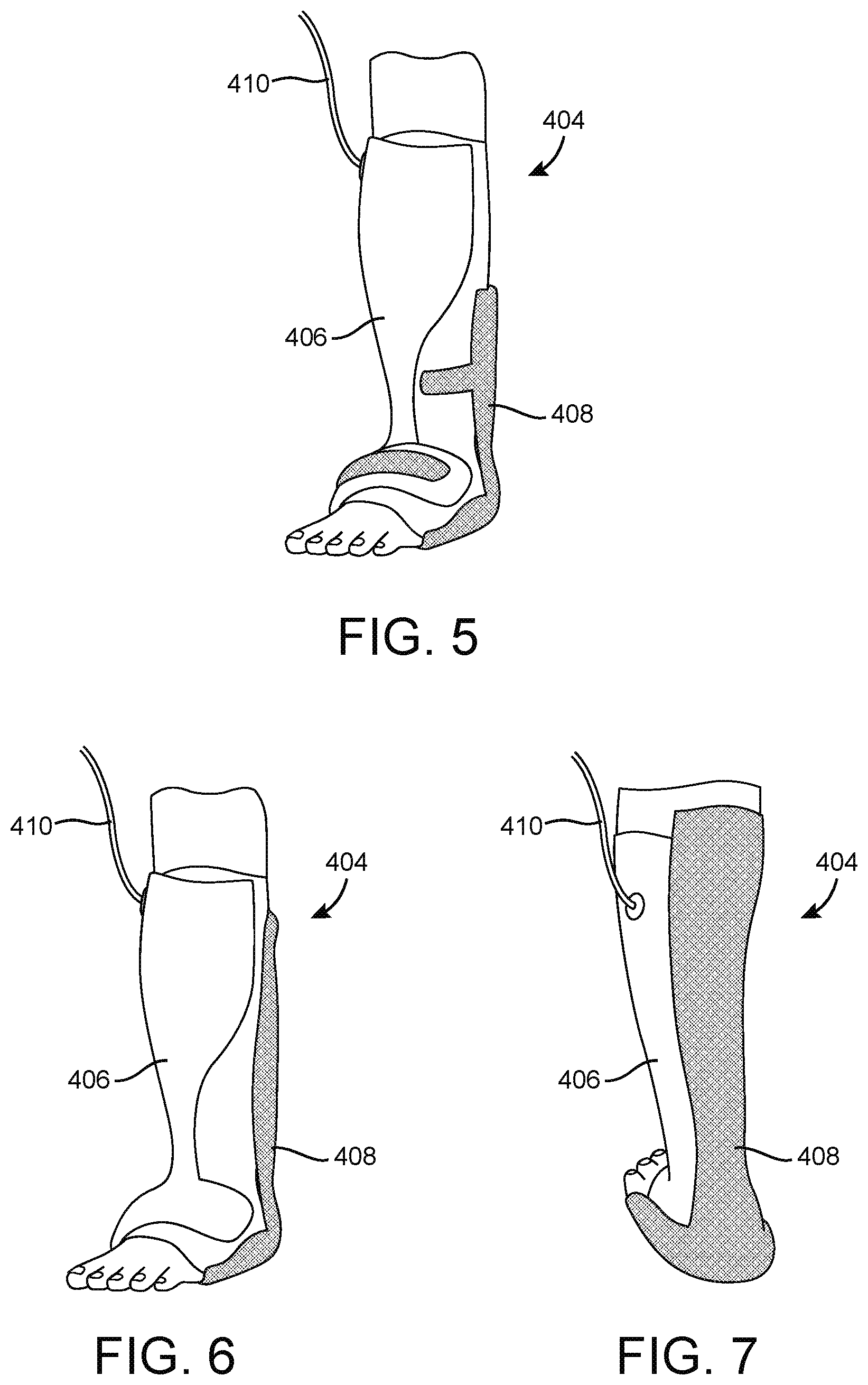 Patent US12616596 Figure 5 – Negative pressure therapy system with immobilizing locking sheets