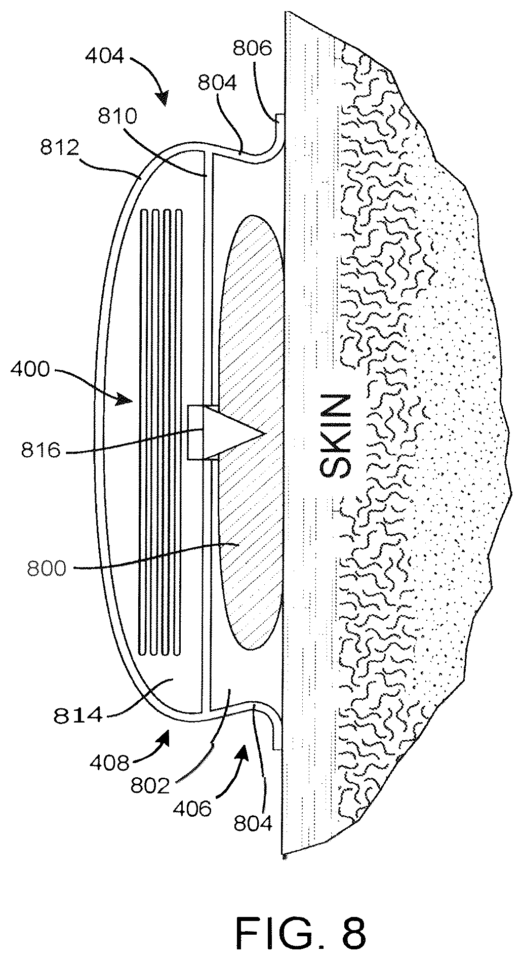 Patent US12616596 Figure 6 – Negative pressure therapy system with immobilizing locking sheets