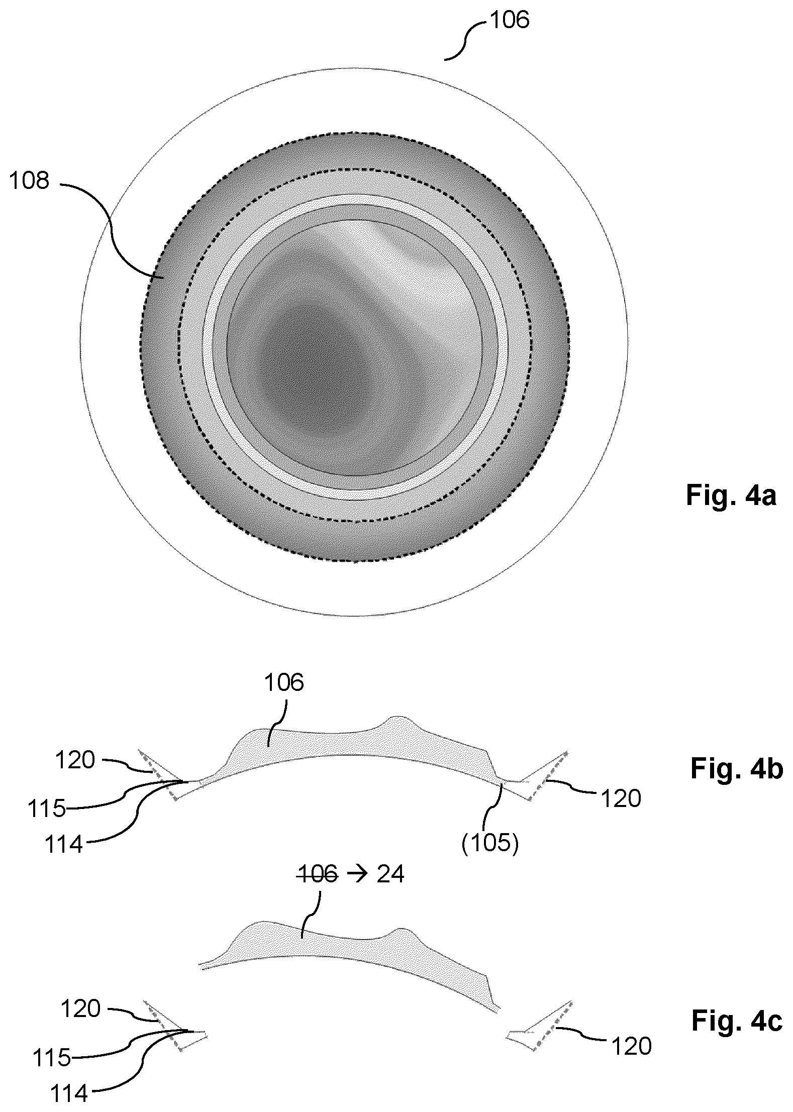 Patent US12616609 Figure 6 – Equipment and methods for refractive surgery, particularly for keratoplasty