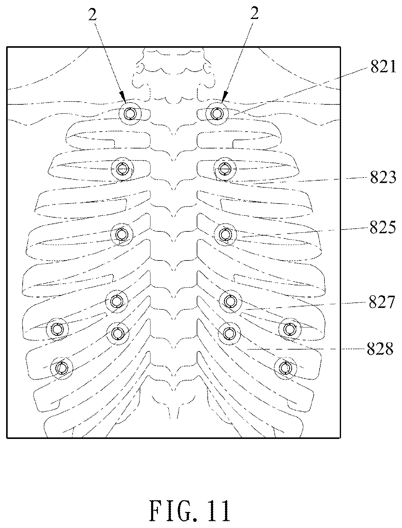 Patent US12616635 Figure 11 – Percussion apparatus for sputum clearance
