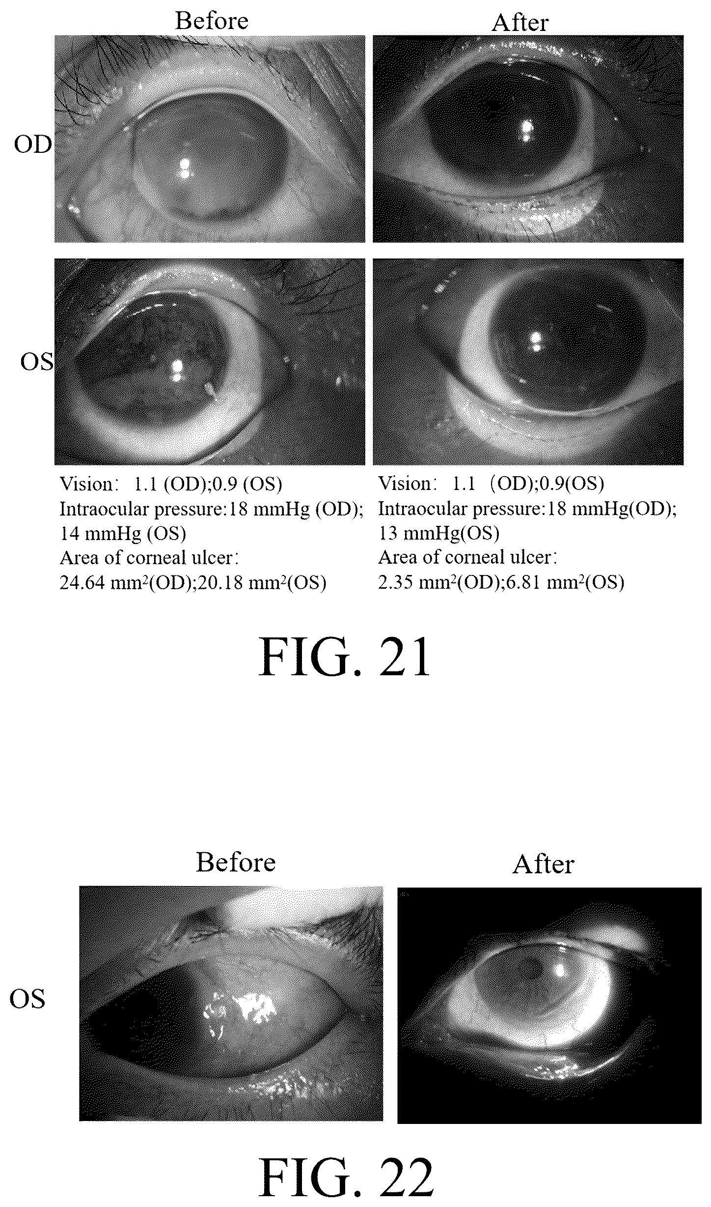 Patent US12616652 Figure 13 – Lenses for treating ocular diseases and preparation method thereof