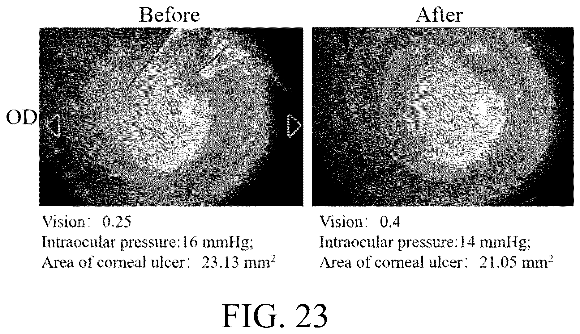 Patent US12616652 Figure 14 – Lenses for treating ocular diseases and preparation method thereof