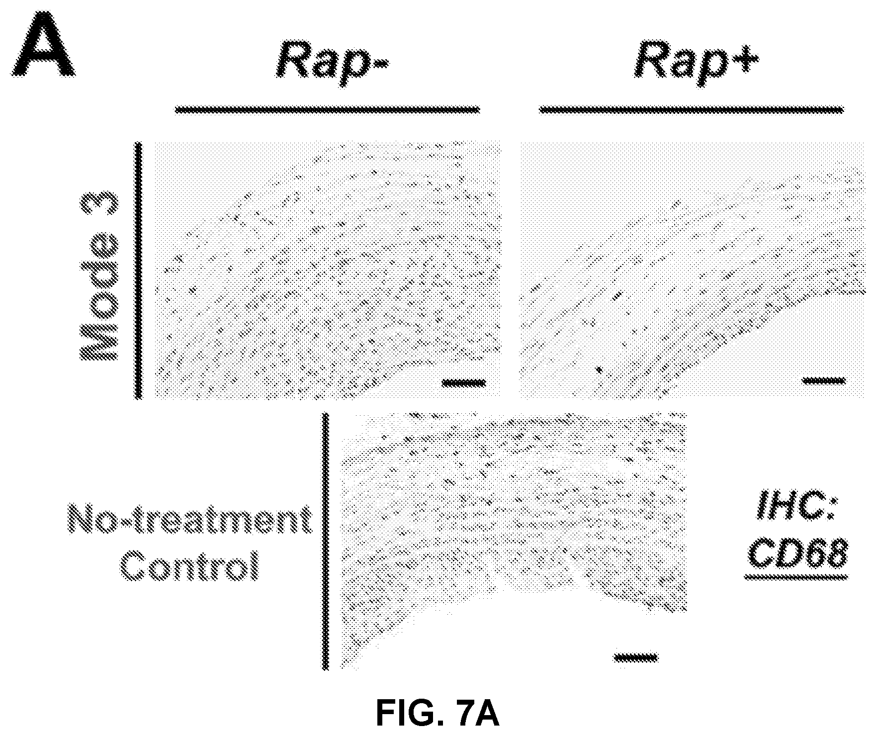 Patent US12616656 Figure 13 – Adventitial painting modality of local drug delivery to abate intimal hyperplasia