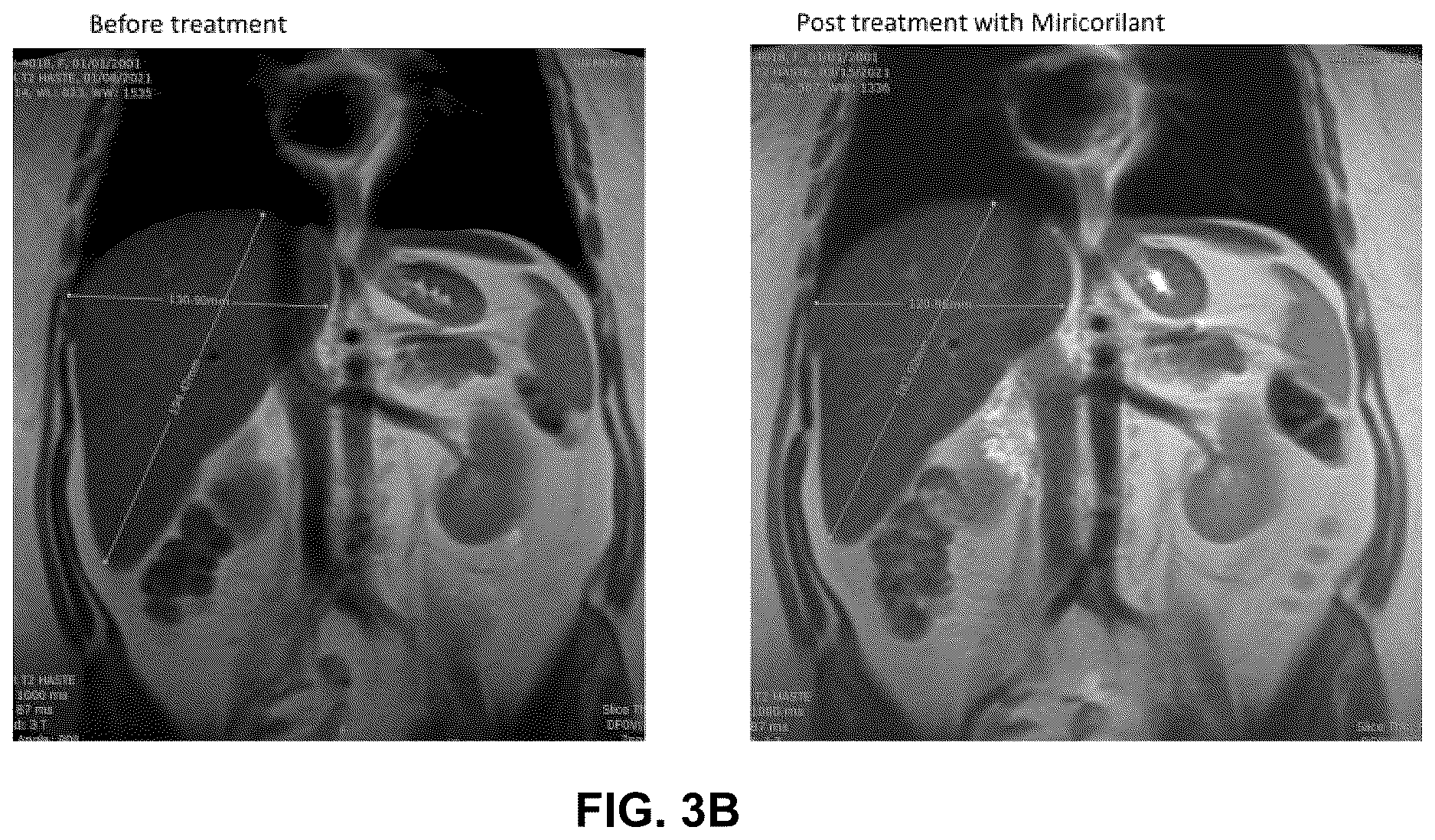 Patent US12616698 Figure 5 – Methods for reducing liver fat and for treating fatty liver disorders