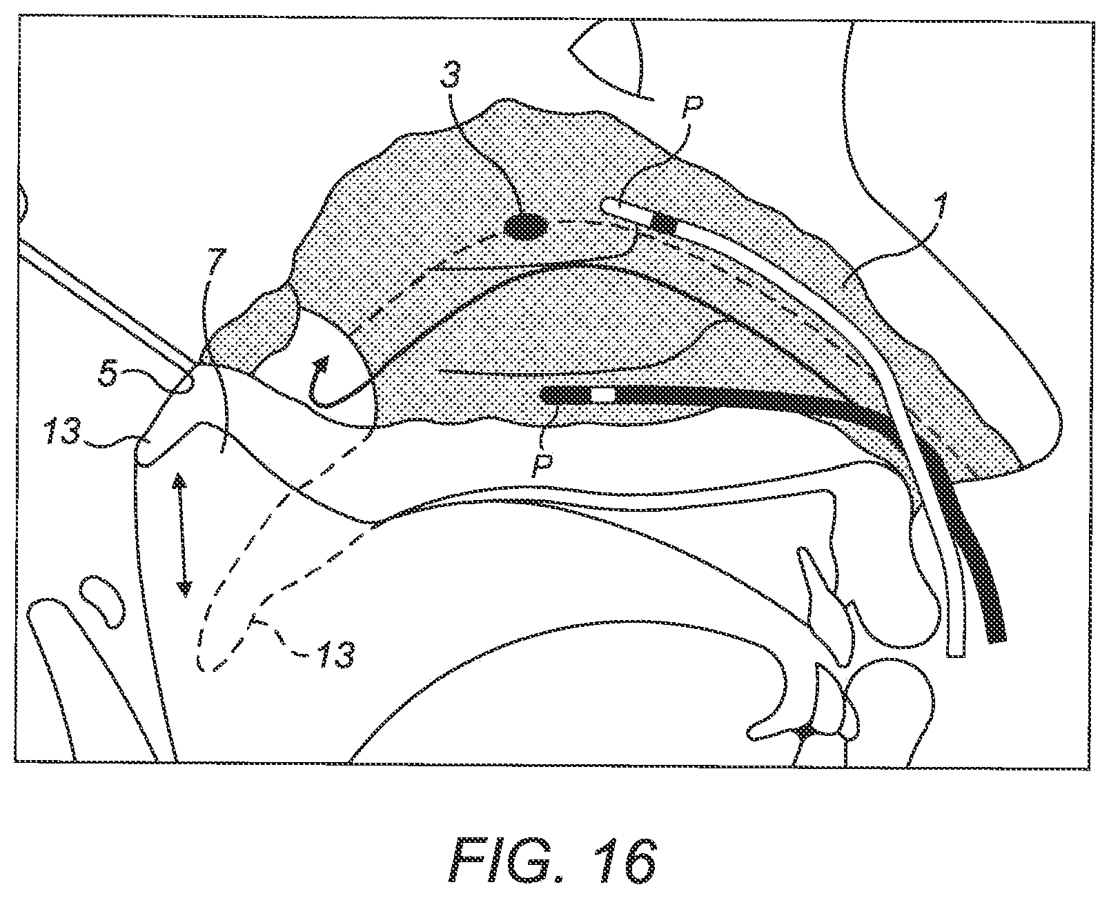 Patent US12616806 Figure 20 – Nasal administration