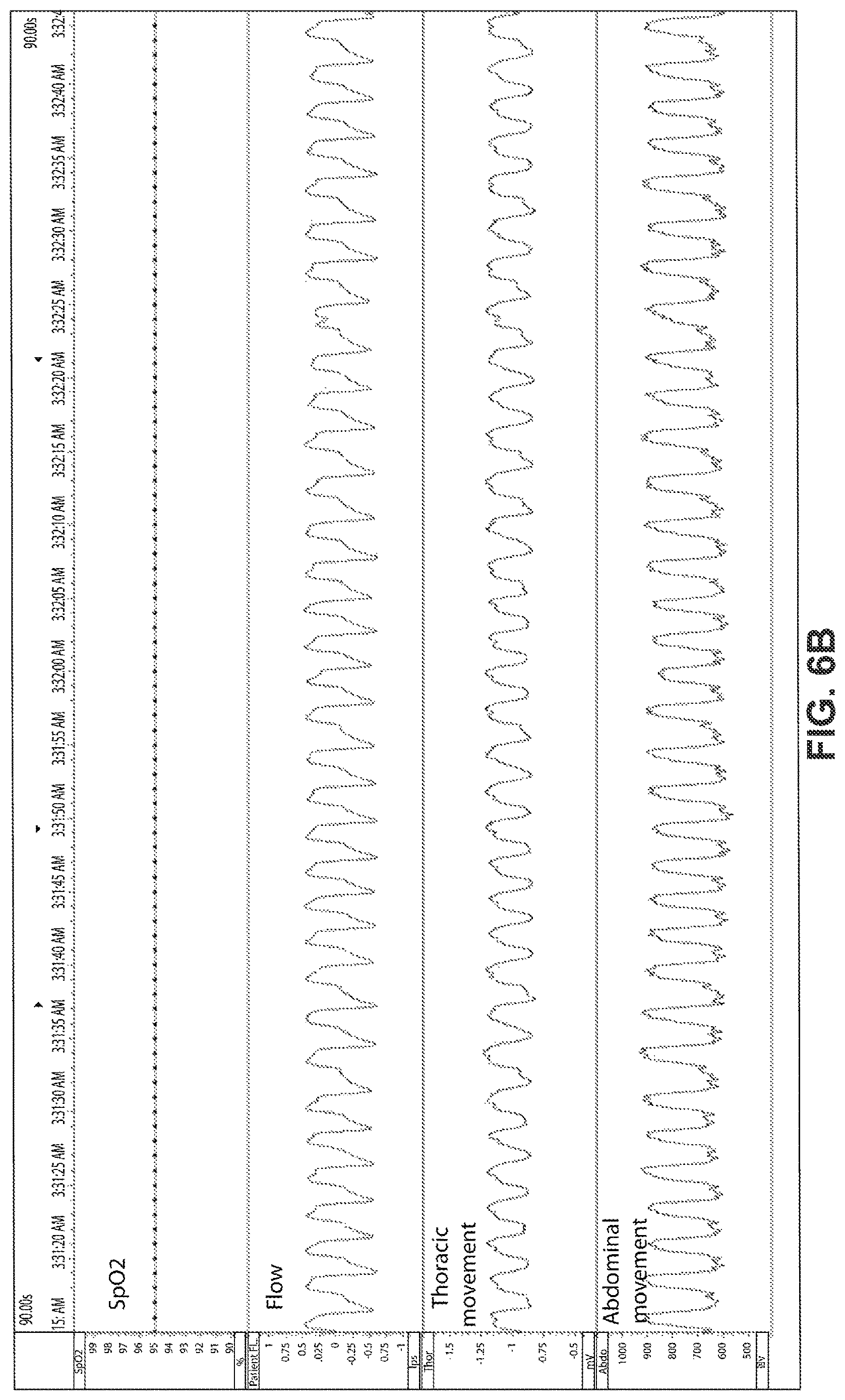 Patent US12616812 Figure 10 – Methods and apparatus for treating respiratory disorders