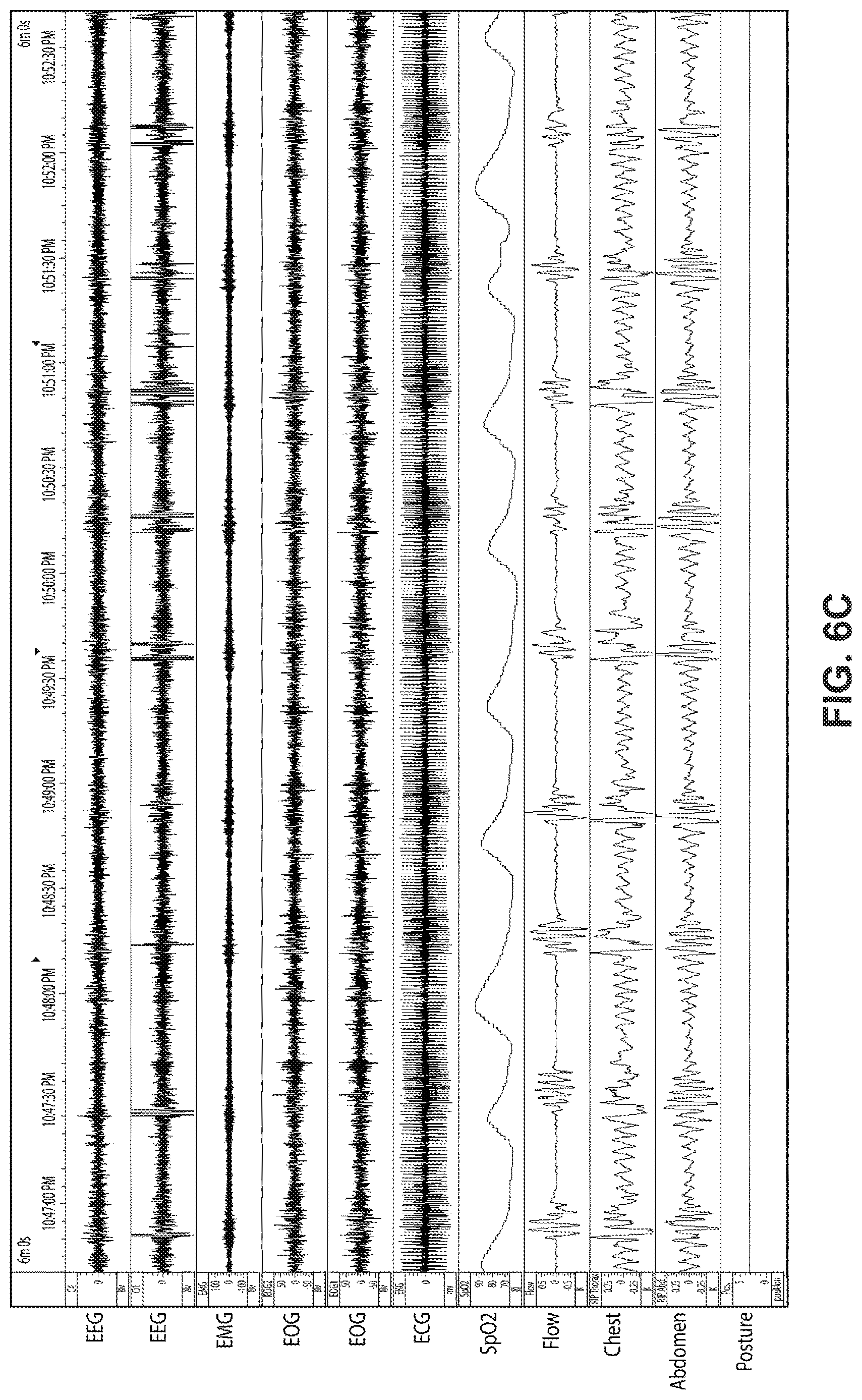 Patent US12616812 Figure 11 – Methods and apparatus for treating respiratory disorders