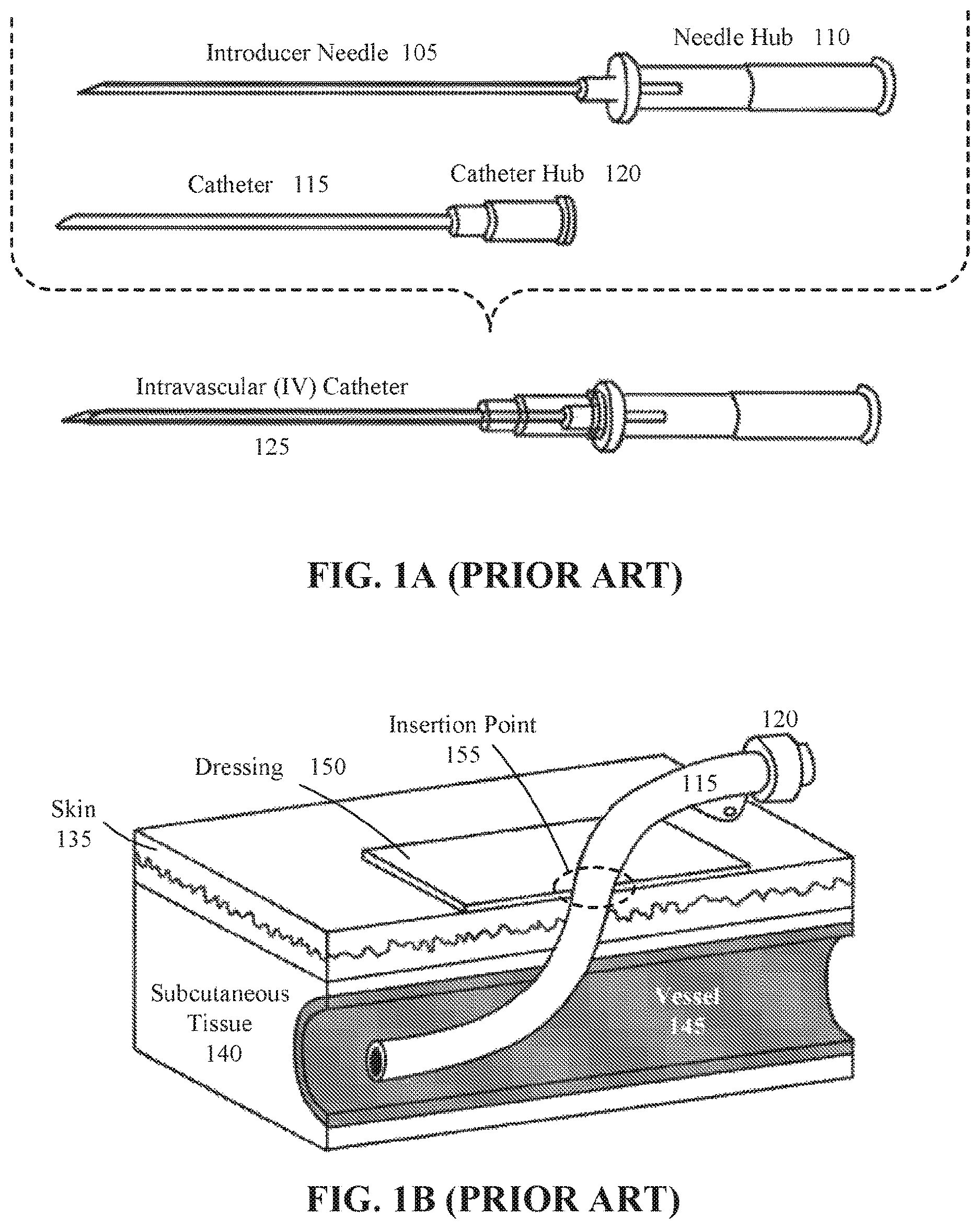 Patent US12616815 Figure 1 – Intravenous catheter reinforced to maintain volumetric integrity