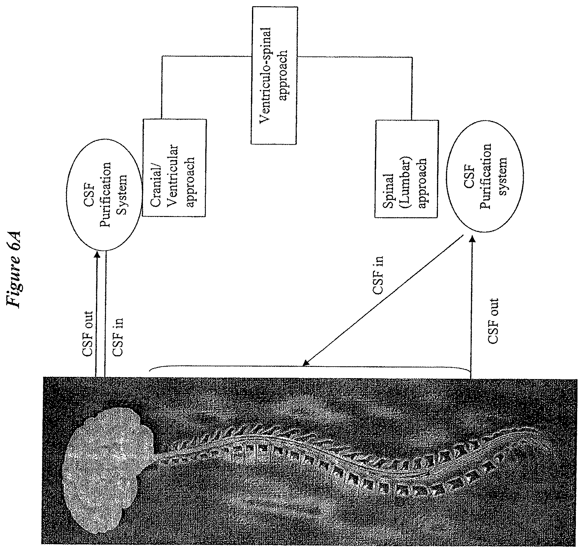 Patent US12616822 Figure 6 – Cerebrospinal fluid purification system