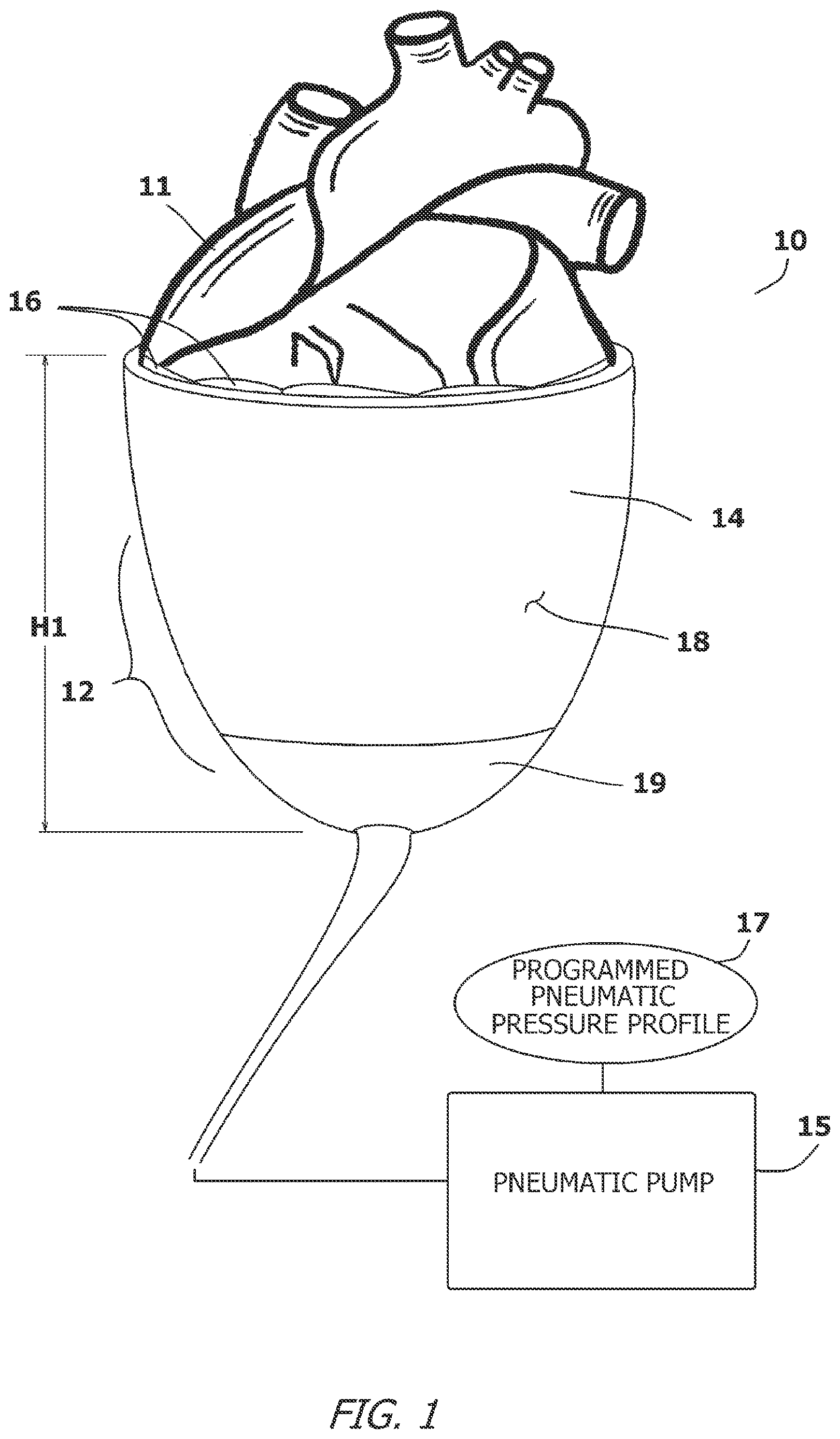 Patent US12616827 Figure 1 – System and method for assisting the heart in pumping blood