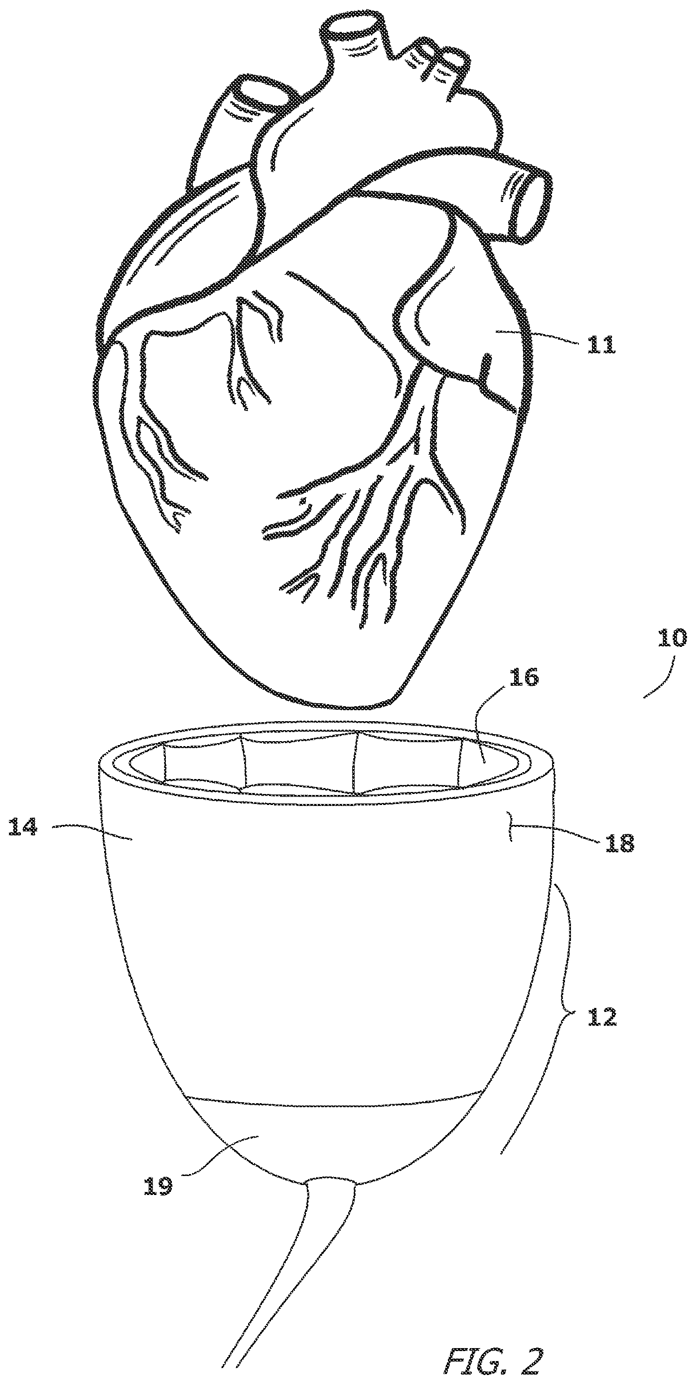 Patent US12616827 Figure 2 – System and method for assisting the heart in pumping blood