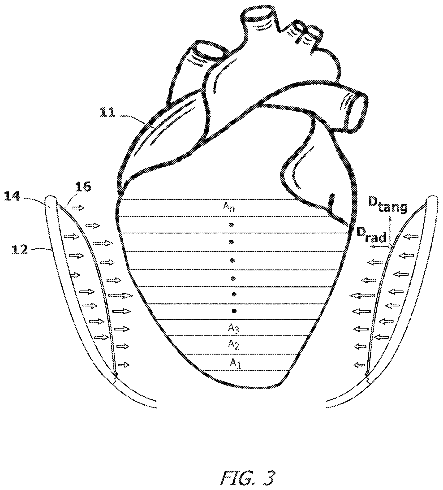 Patent US12616827 Figure 3 – System and method for assisting the heart in pumping blood