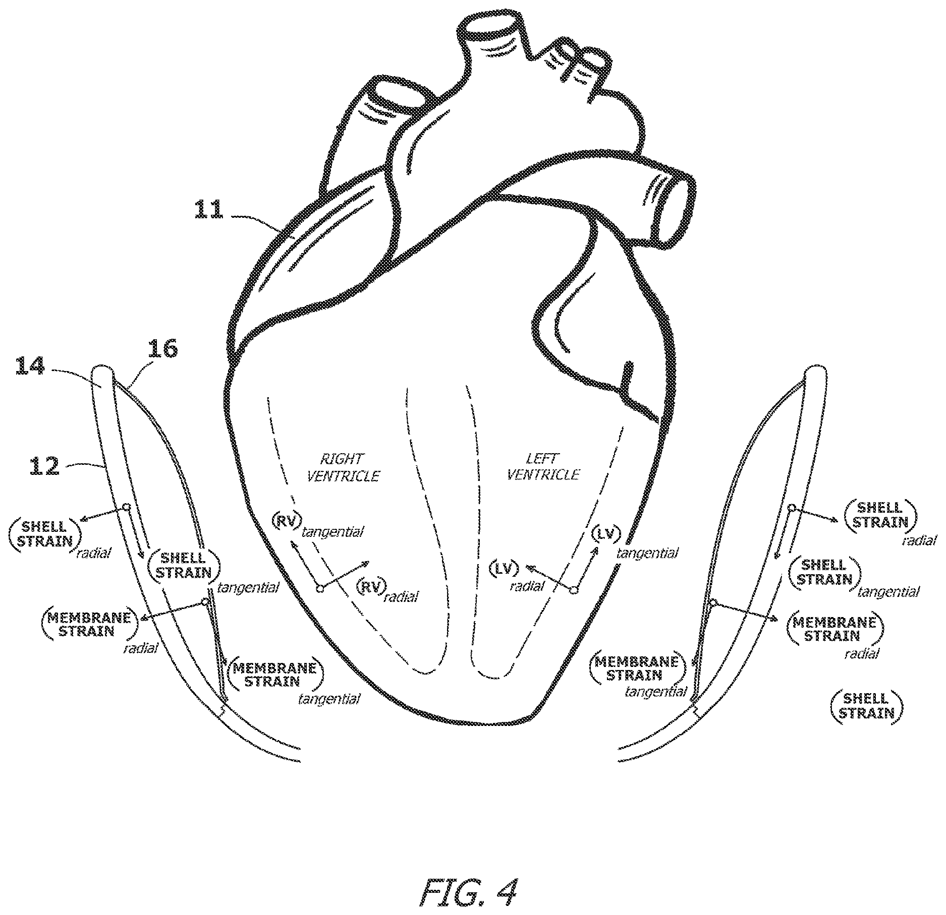 Patent US12616827 Figure 4 – System and method for assisting the heart in pumping blood