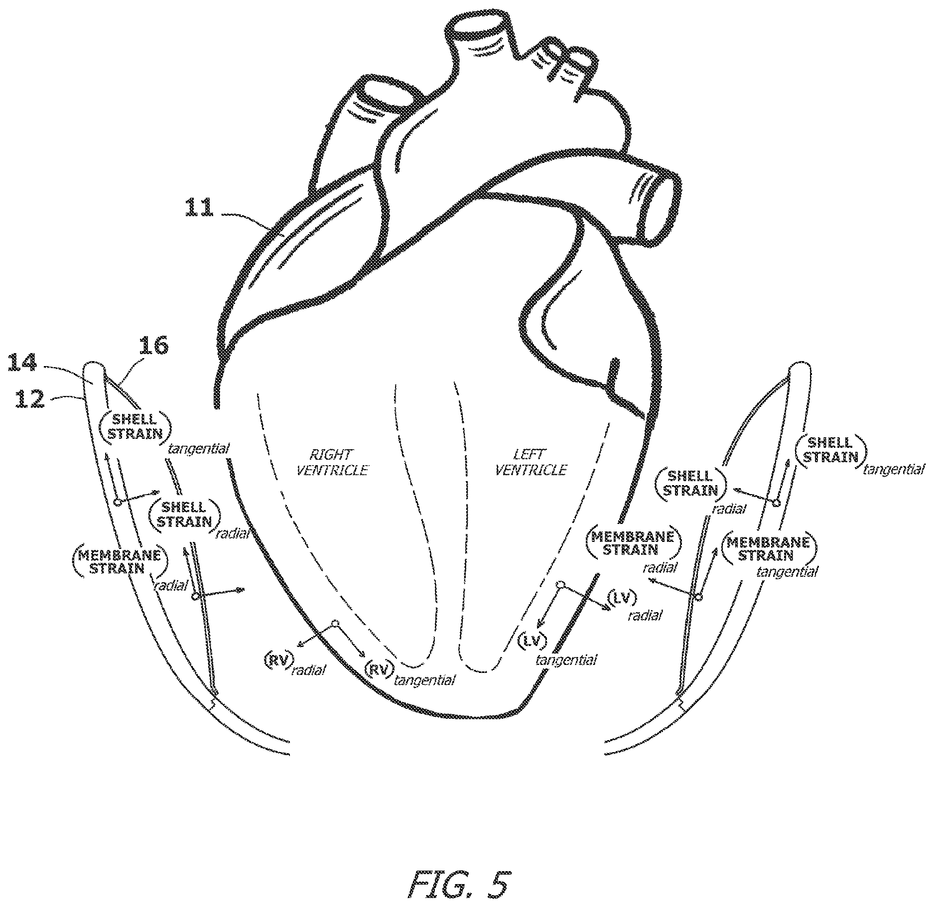 Patent US12616827 Figure 5 – System and method for assisting the heart in pumping blood