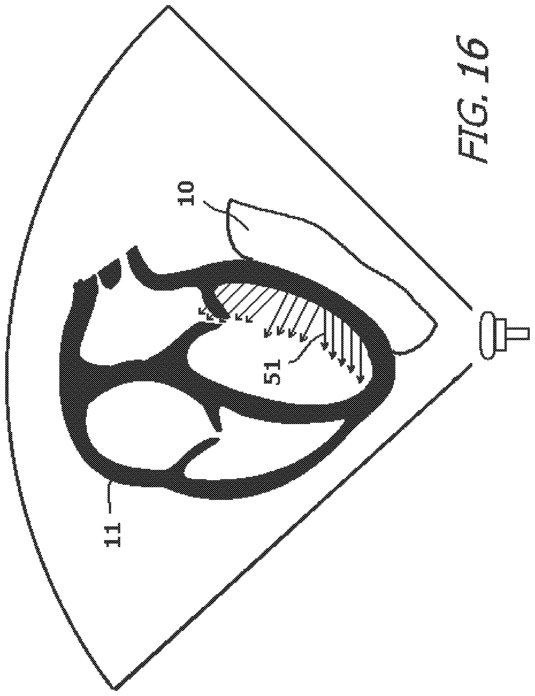 Patent US12616827 Figure 16 – System and method for assisting the heart in pumping blood