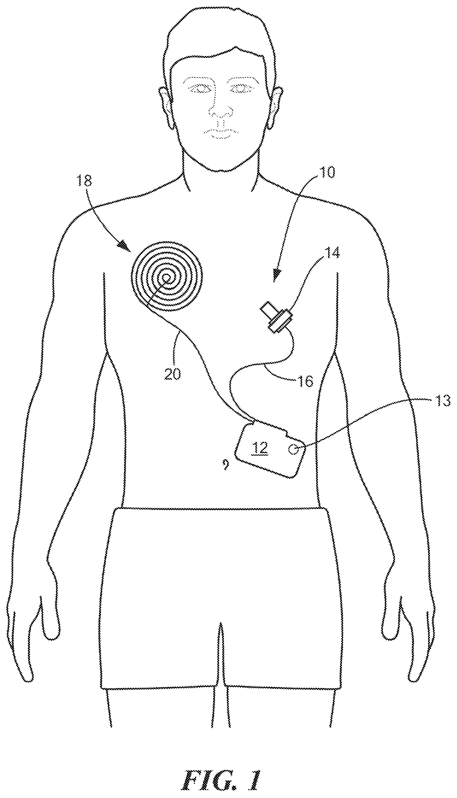 Patent US12616828 Figure 1 – Detecting heating of implanted coil hermetic package when misaligned