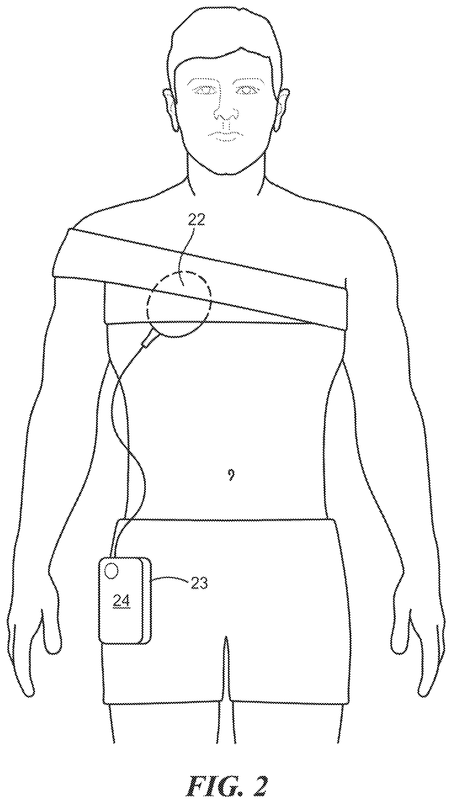 Patent US12616828 Figure 2 – Detecting heating of implanted coil hermetic package when misaligned