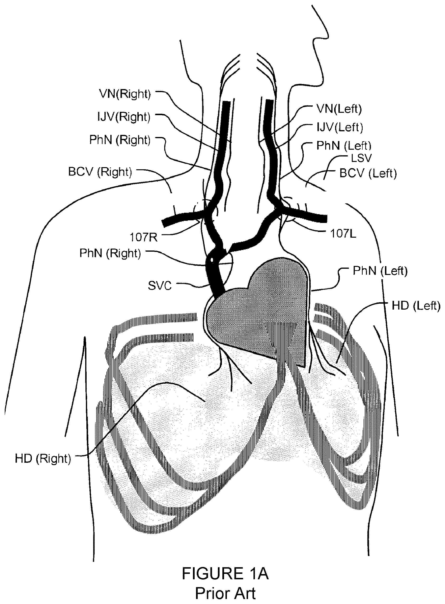 Patent US12616831 Figure 1 – Transvascular nerve stimulation apparatus and methods