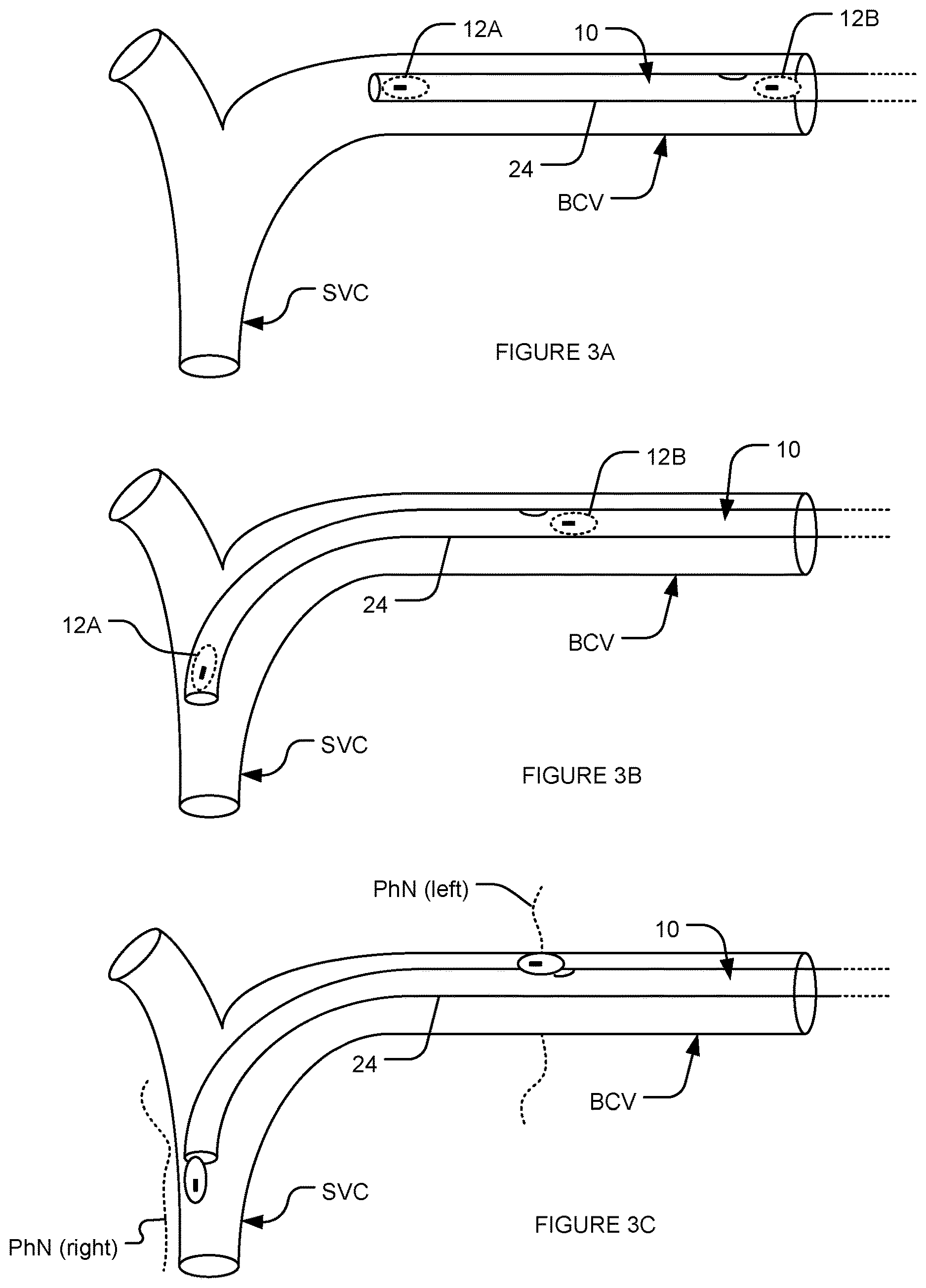 Patent US12616831 Figure 3 – Transvascular nerve stimulation apparatus and methods