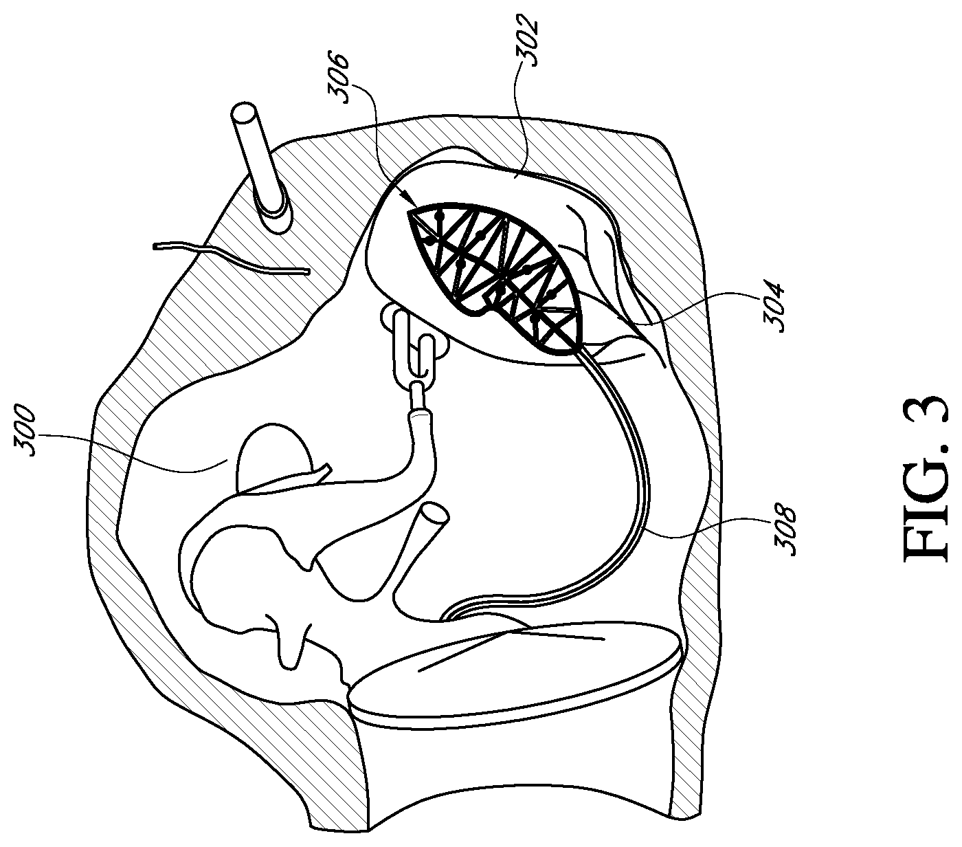 Patent US12616837 Figure 3 – Methods and apparatuses for extracochlear stimulation