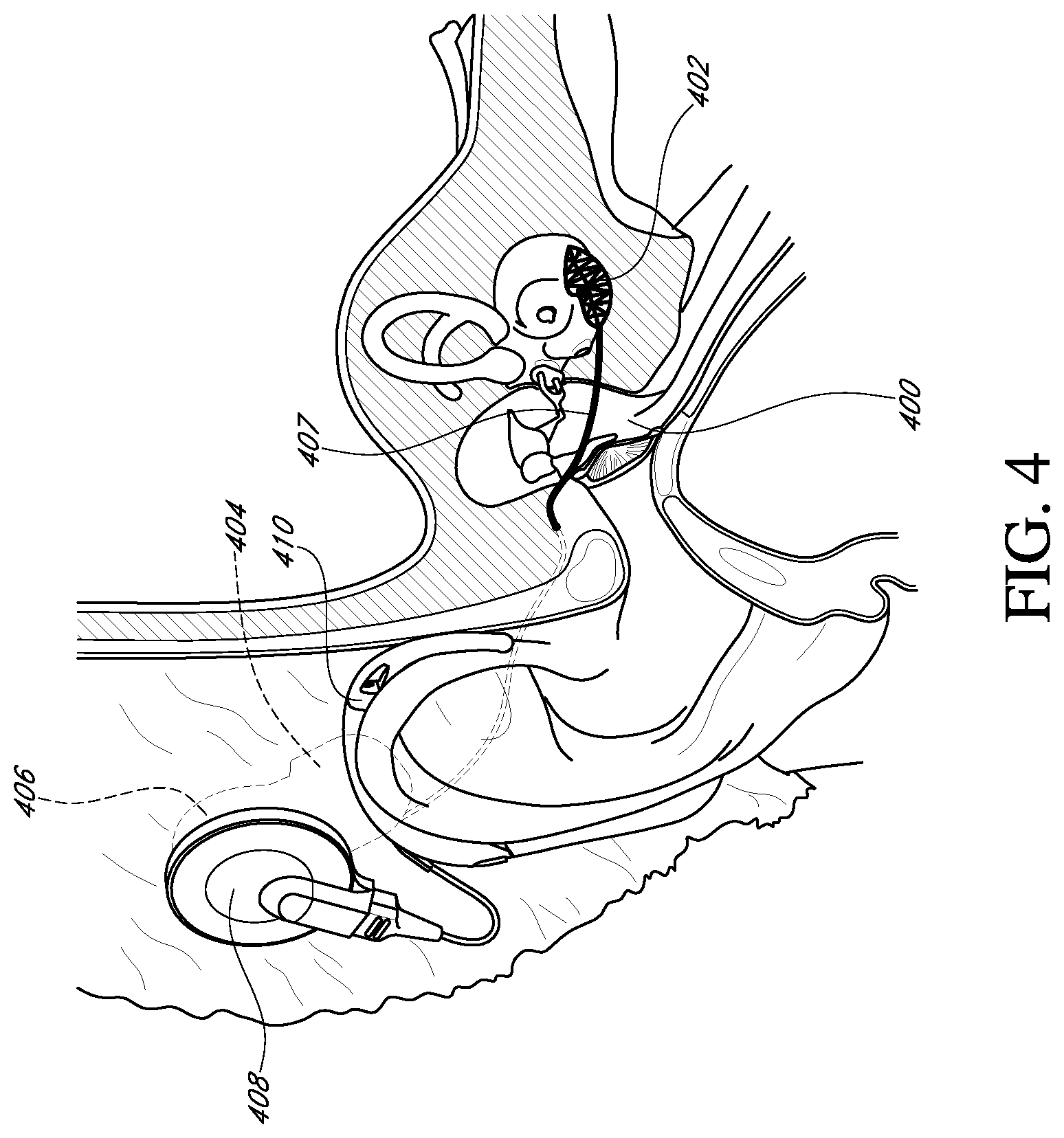 Patent US12616837 Figure 4 – Methods and apparatuses for extracochlear stimulation