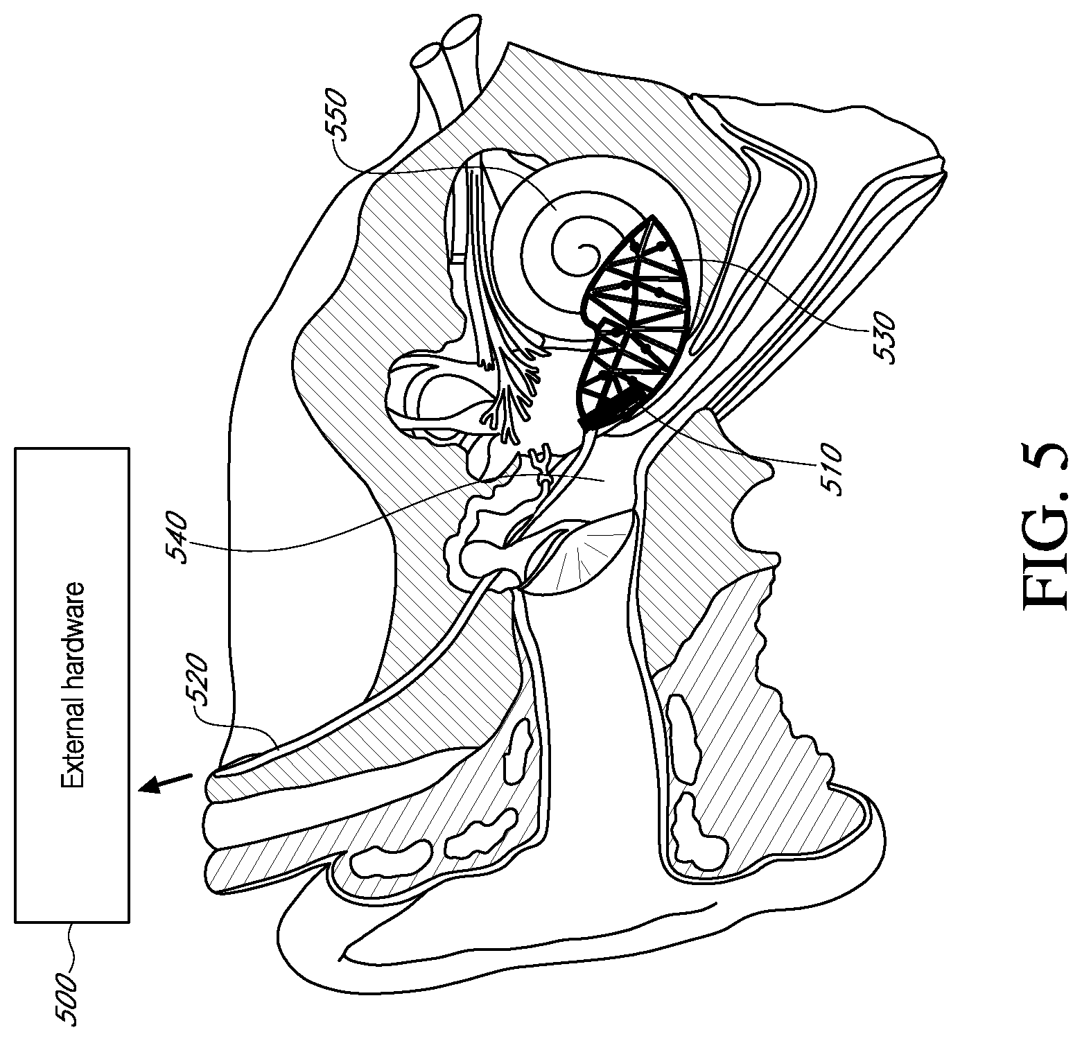 Patent US12616837 Figure 5 – Methods and apparatuses for extracochlear stimulation