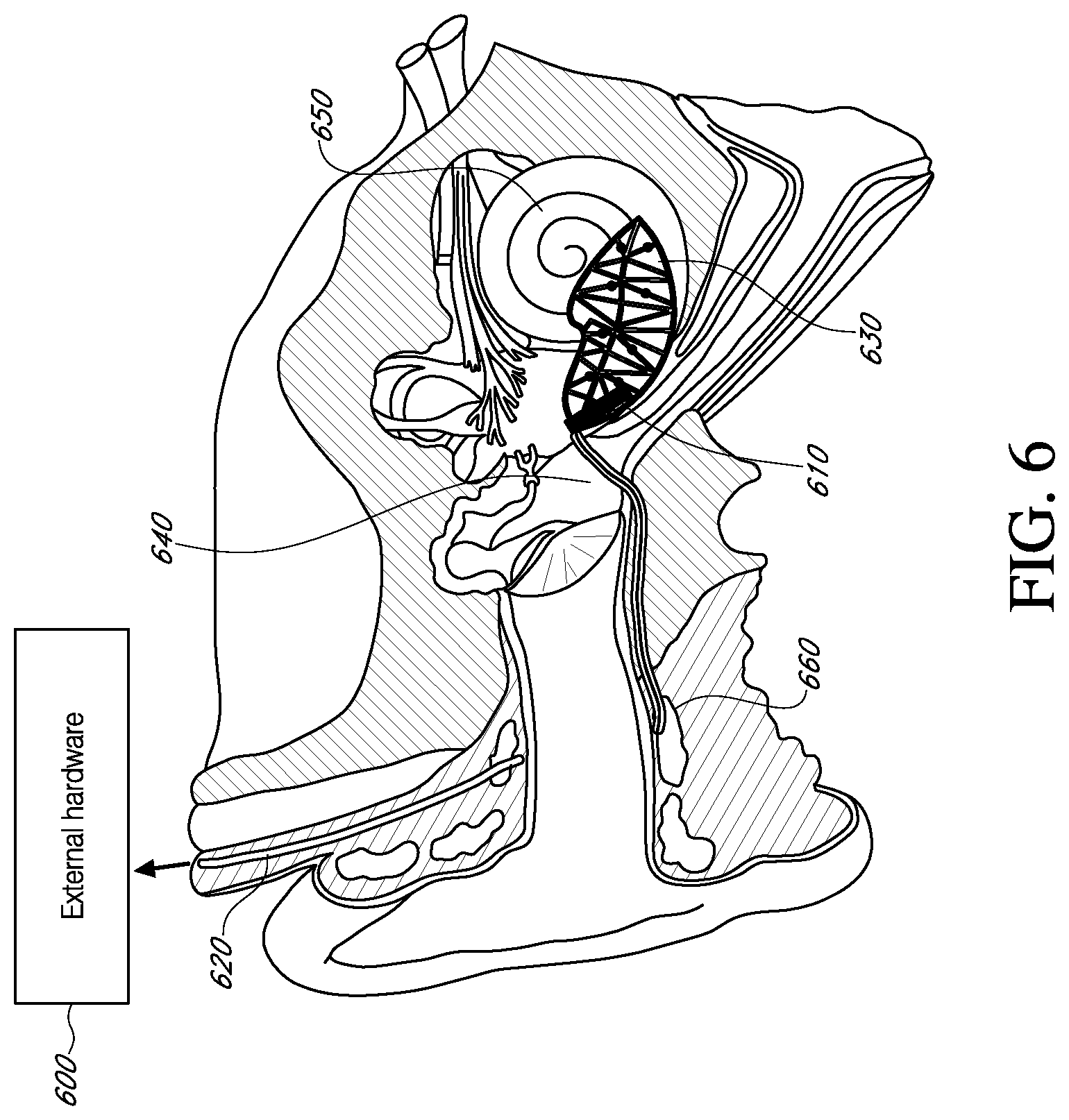 Patent US12616837 Figure 6 – Methods and apparatuses for extracochlear stimulation