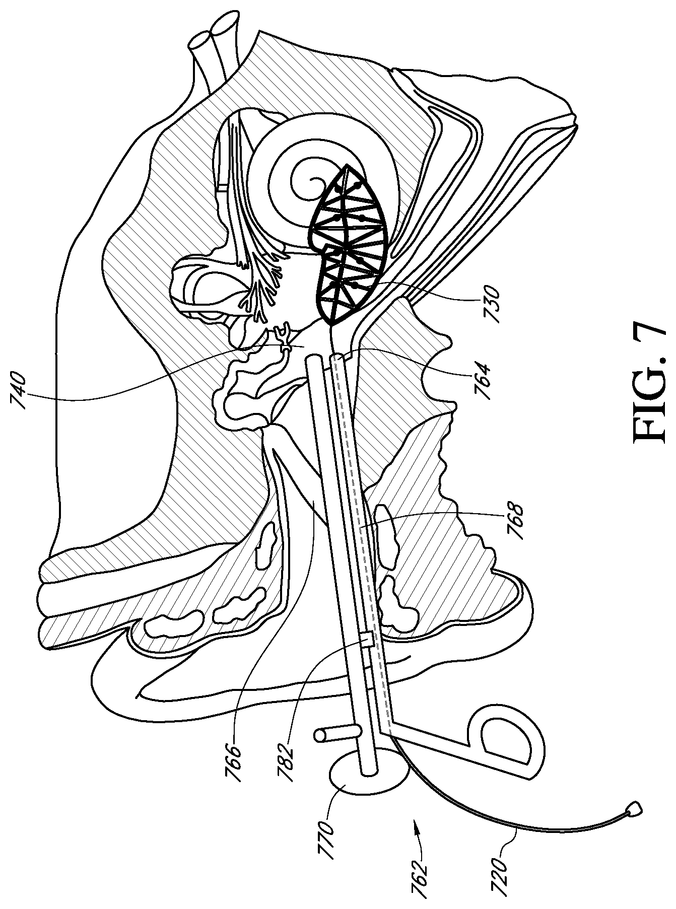 Patent US12616837 Figure 7 – Methods and apparatuses for extracochlear stimulation