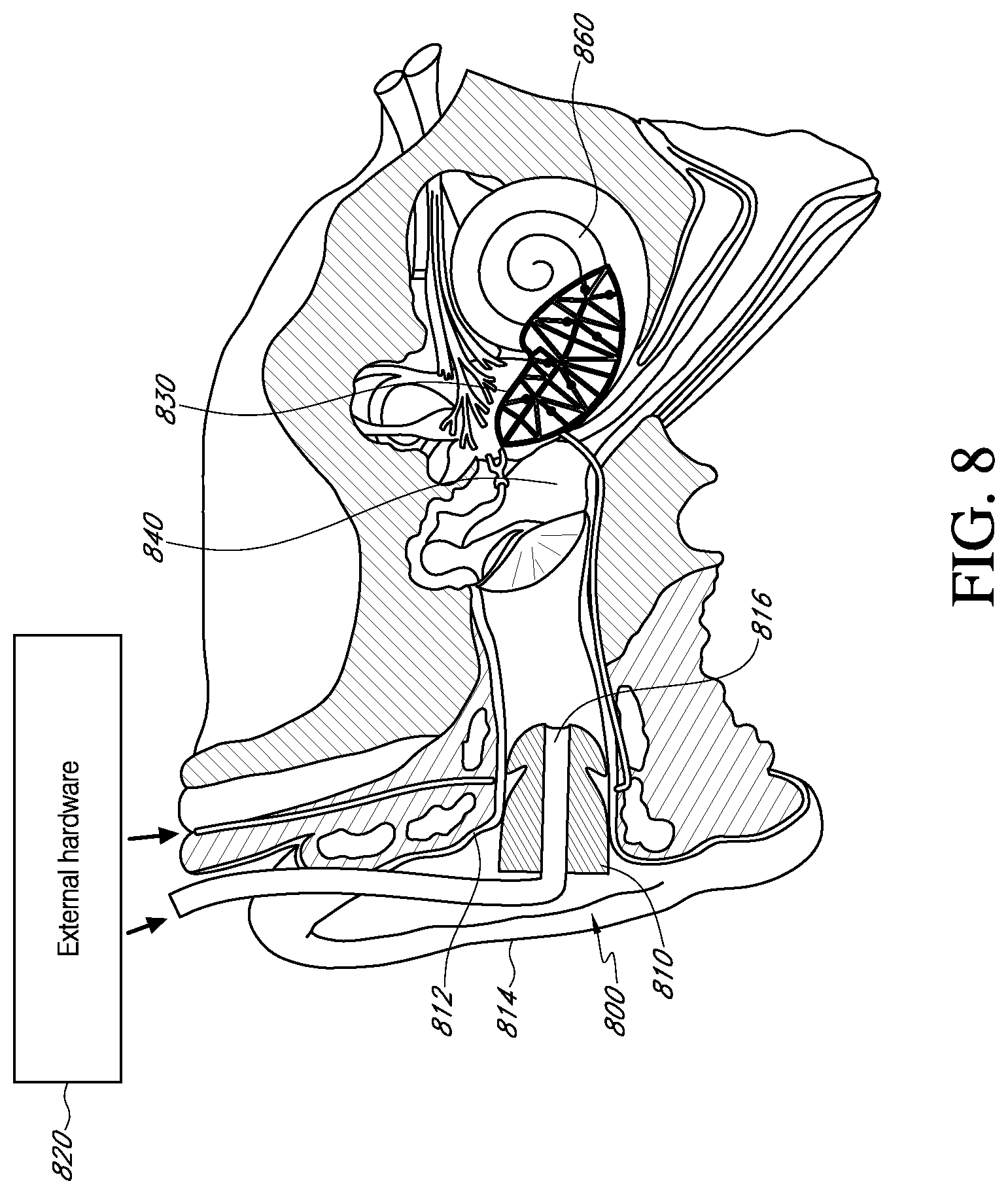 Patent US12616837 Figure 8 – Methods and apparatuses for extracochlear stimulation